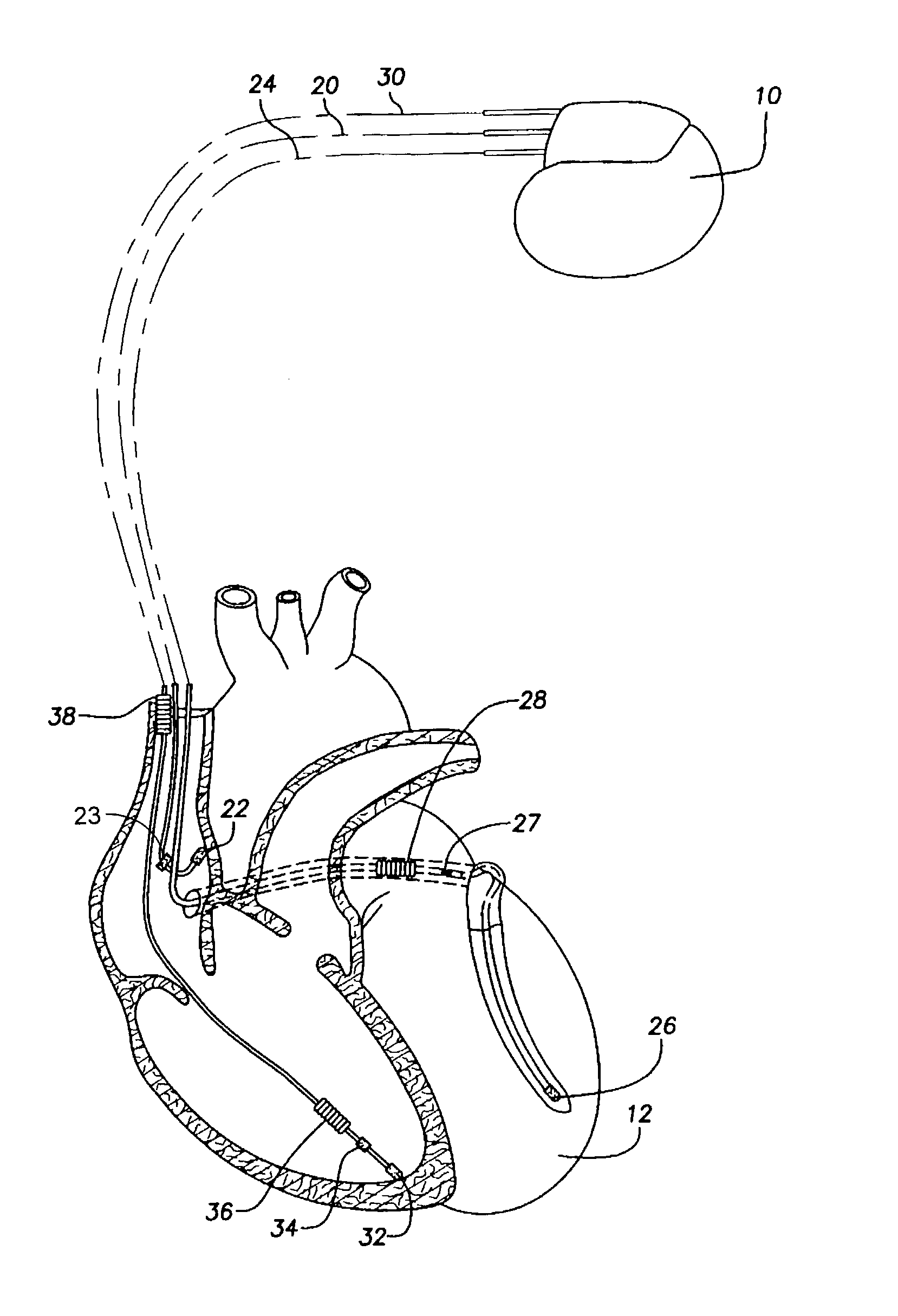 System and method for rejecting far-field signals using an implantable cardiac stimulation device