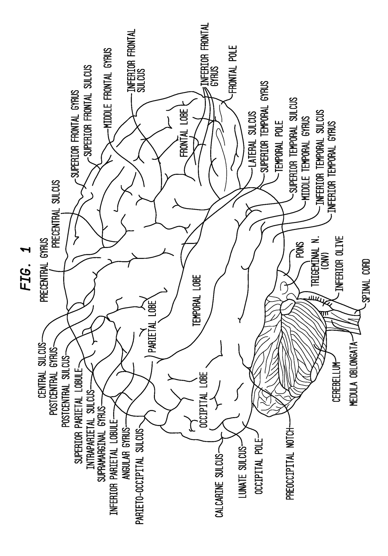 Formulations of site-specific, microparticulate compositions and their use to improve outcome after aneursymal subarachnoid hemorrhage