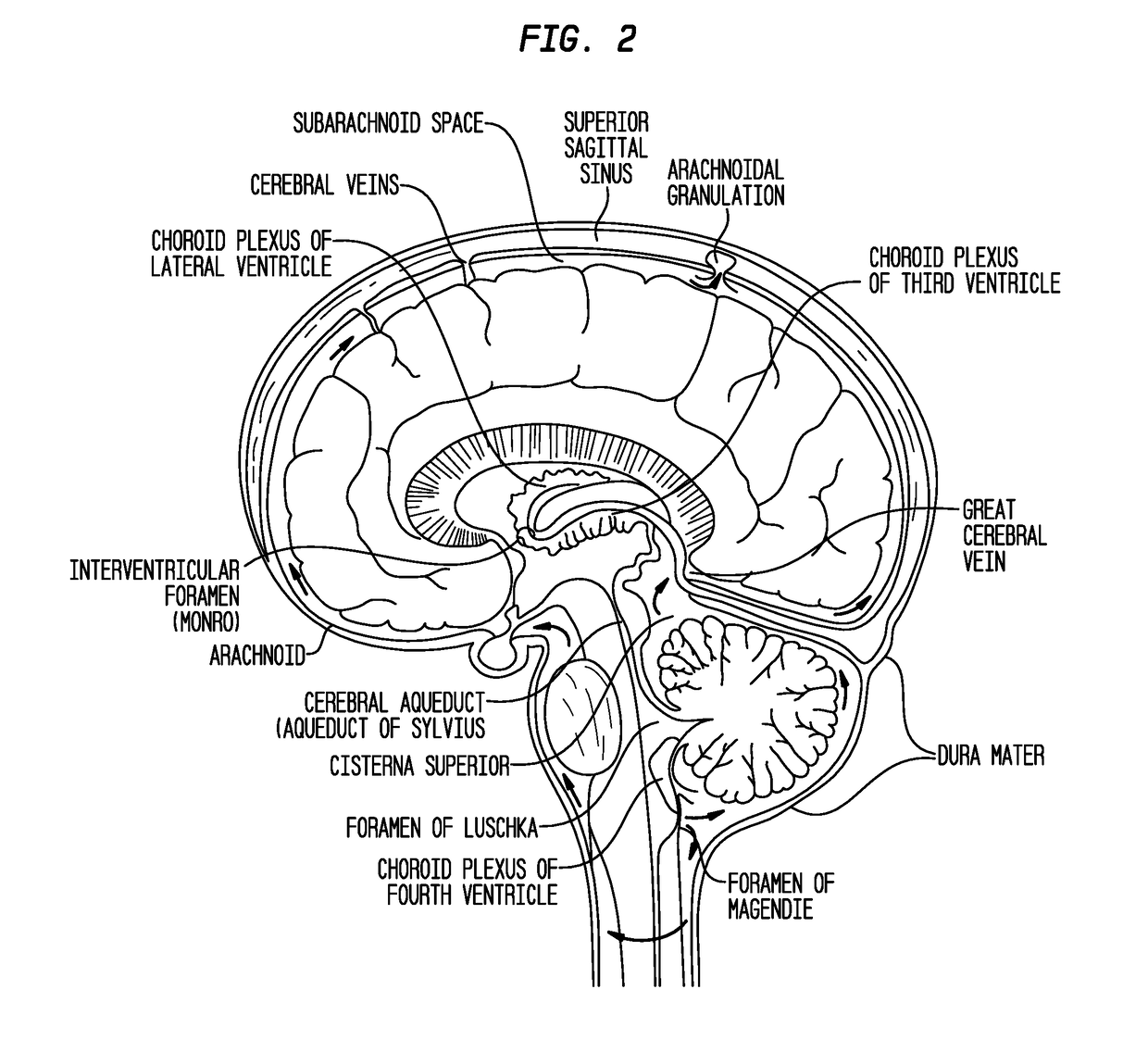 Formulations of site-specific, microparticulate compositions and their use to improve outcome after aneursymal subarachnoid hemorrhage