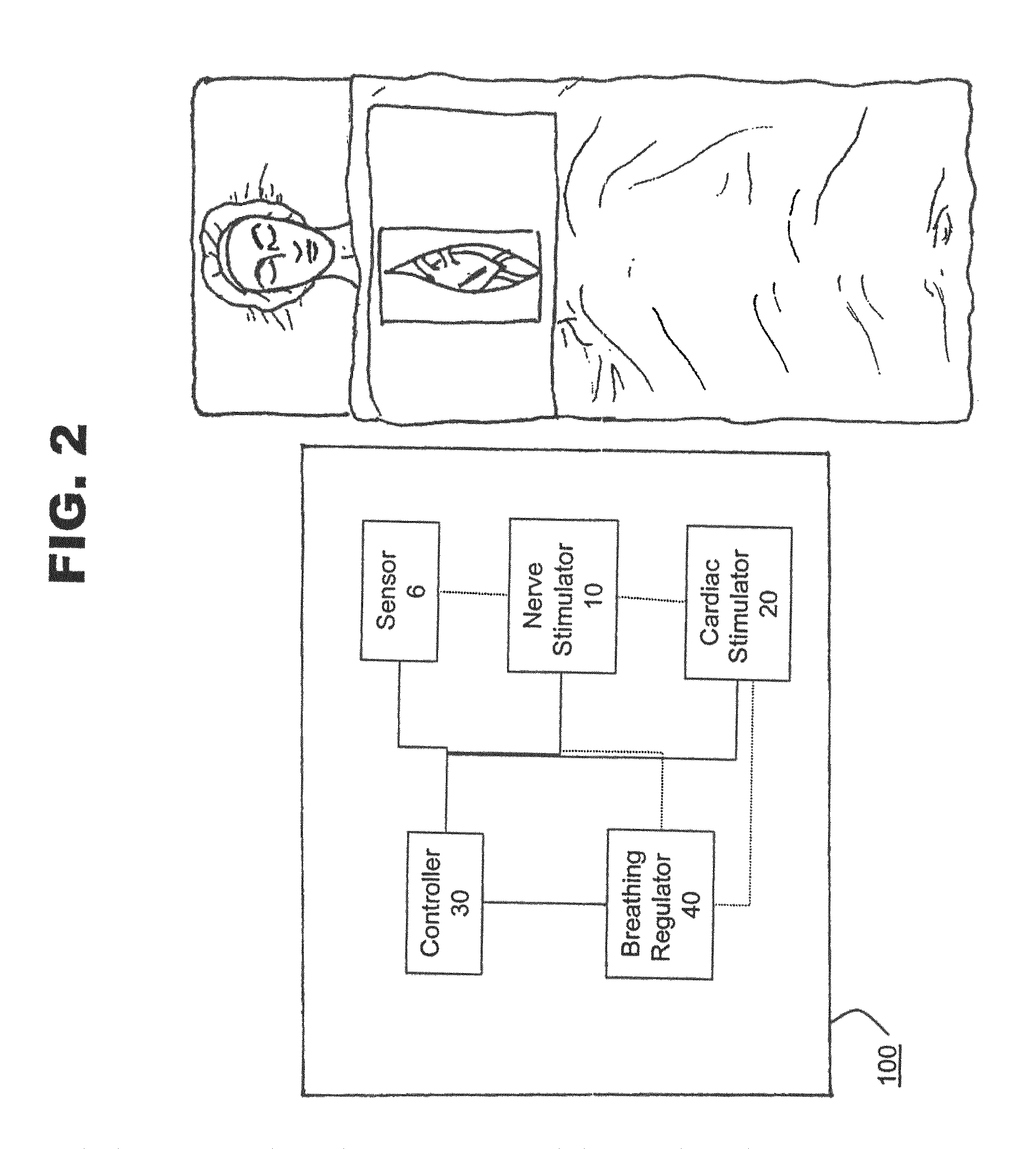 Method and system for nerve stimulation and cardiac sensing prior to and during a medical procedure