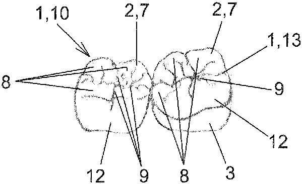 Partial dental prosthesis