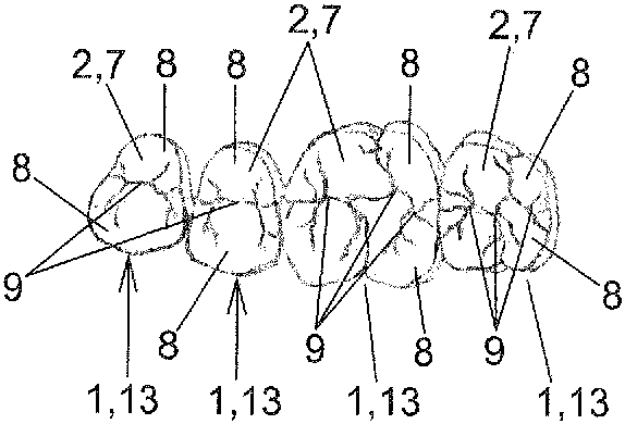 Partial dental prosthesis