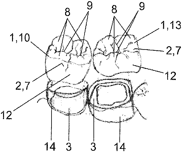 Partial dental prosthesis