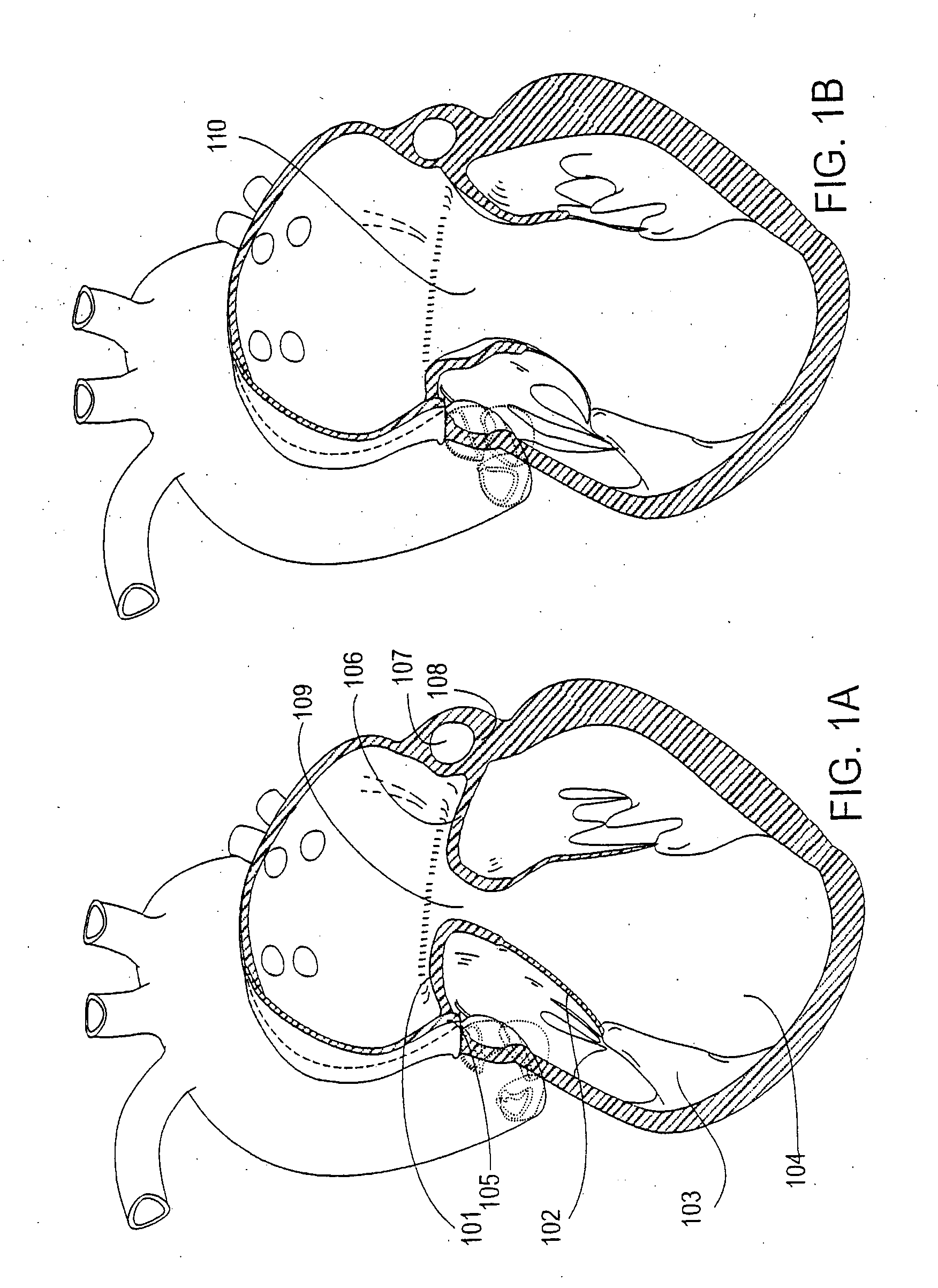 Atrioventricular valve annulus repair systems and methods including retro-chordal anchors