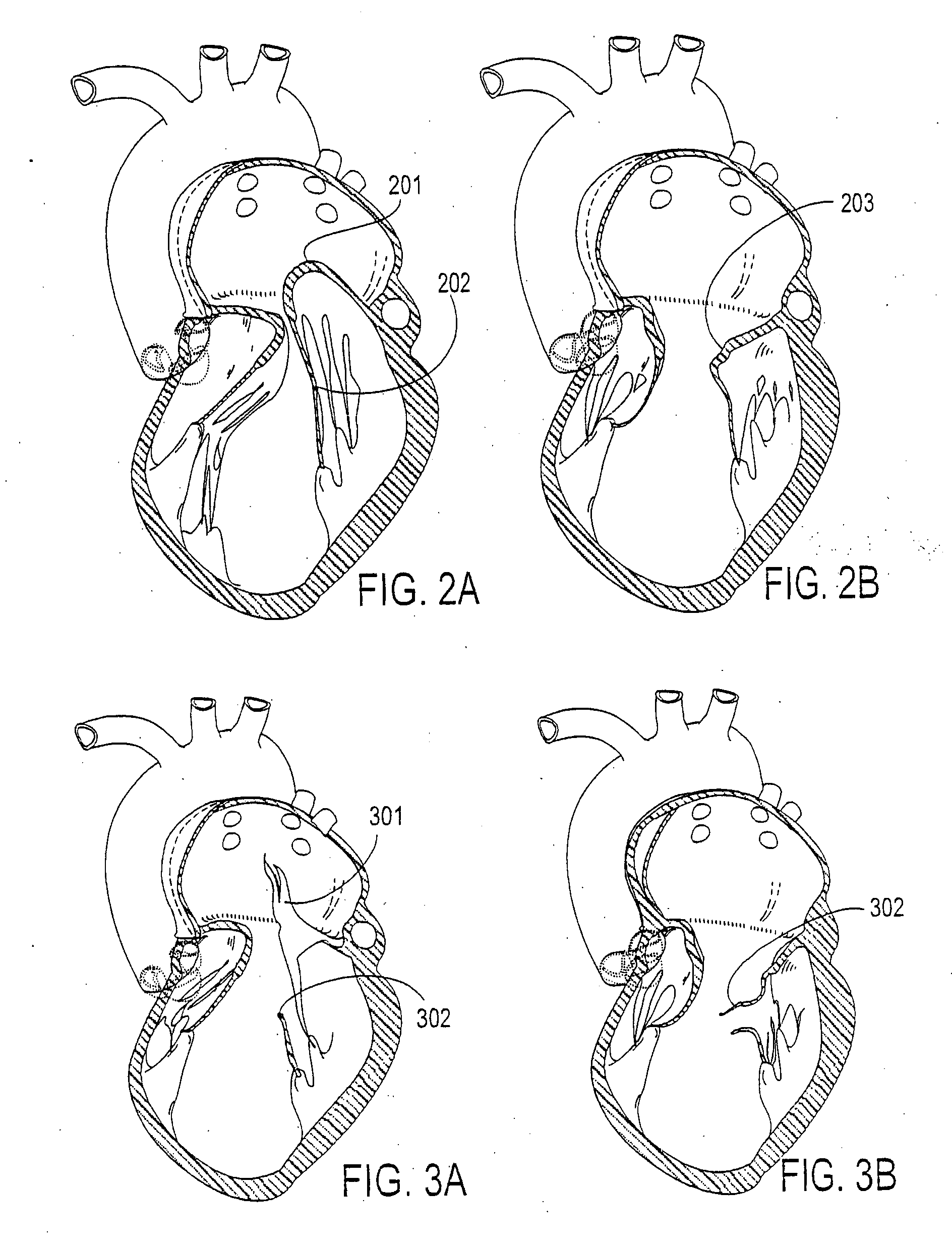 Atrioventricular valve annulus repair systems and methods including retro-chordal anchors