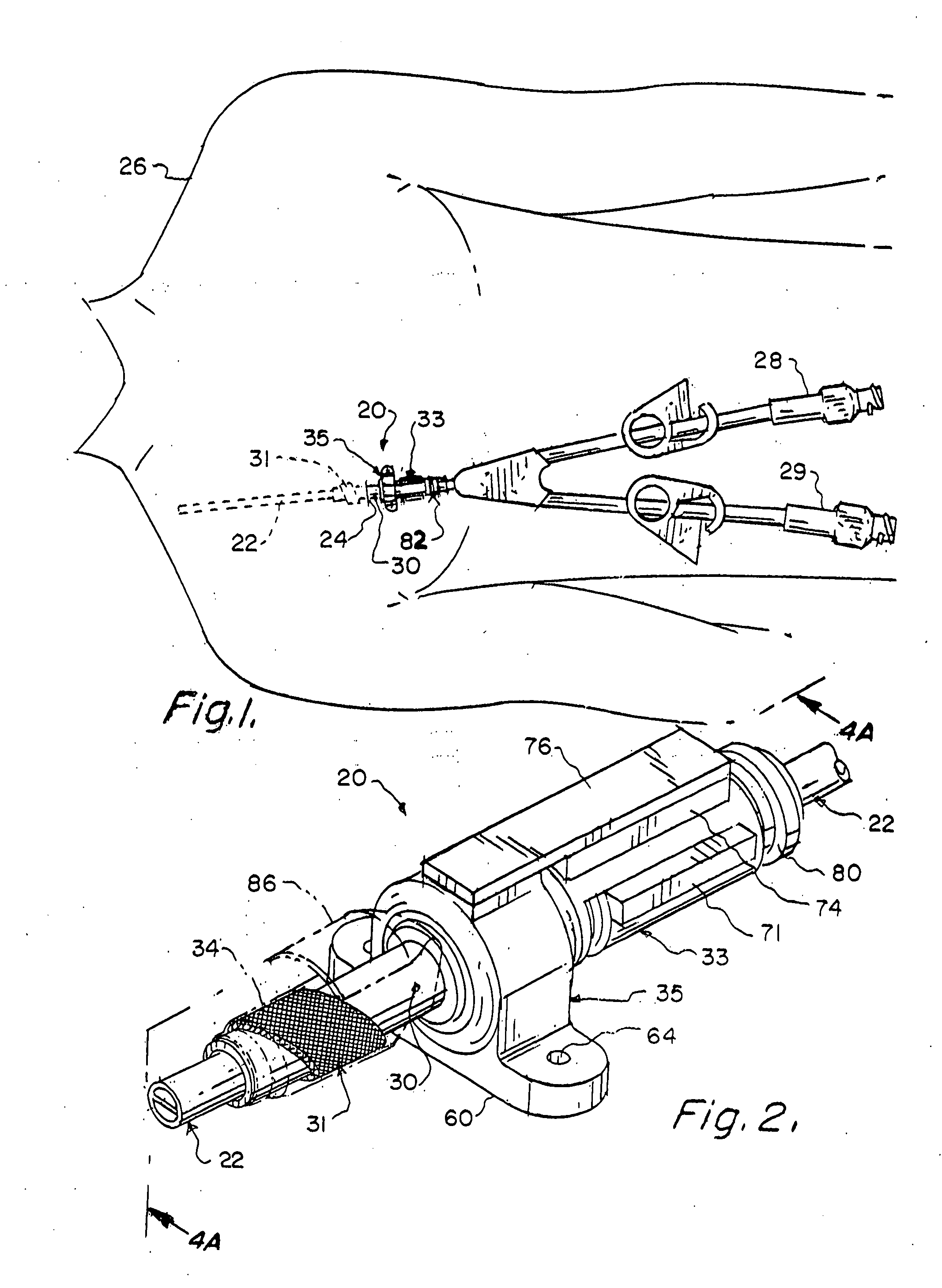 Apparatus and method for percutaneous catheter implantation and replacement
