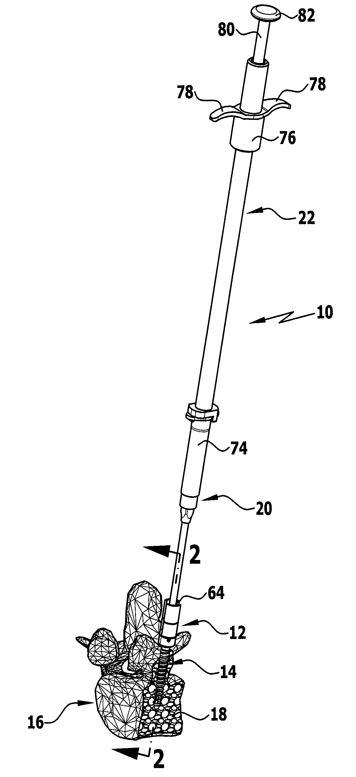 Implant and implantation system