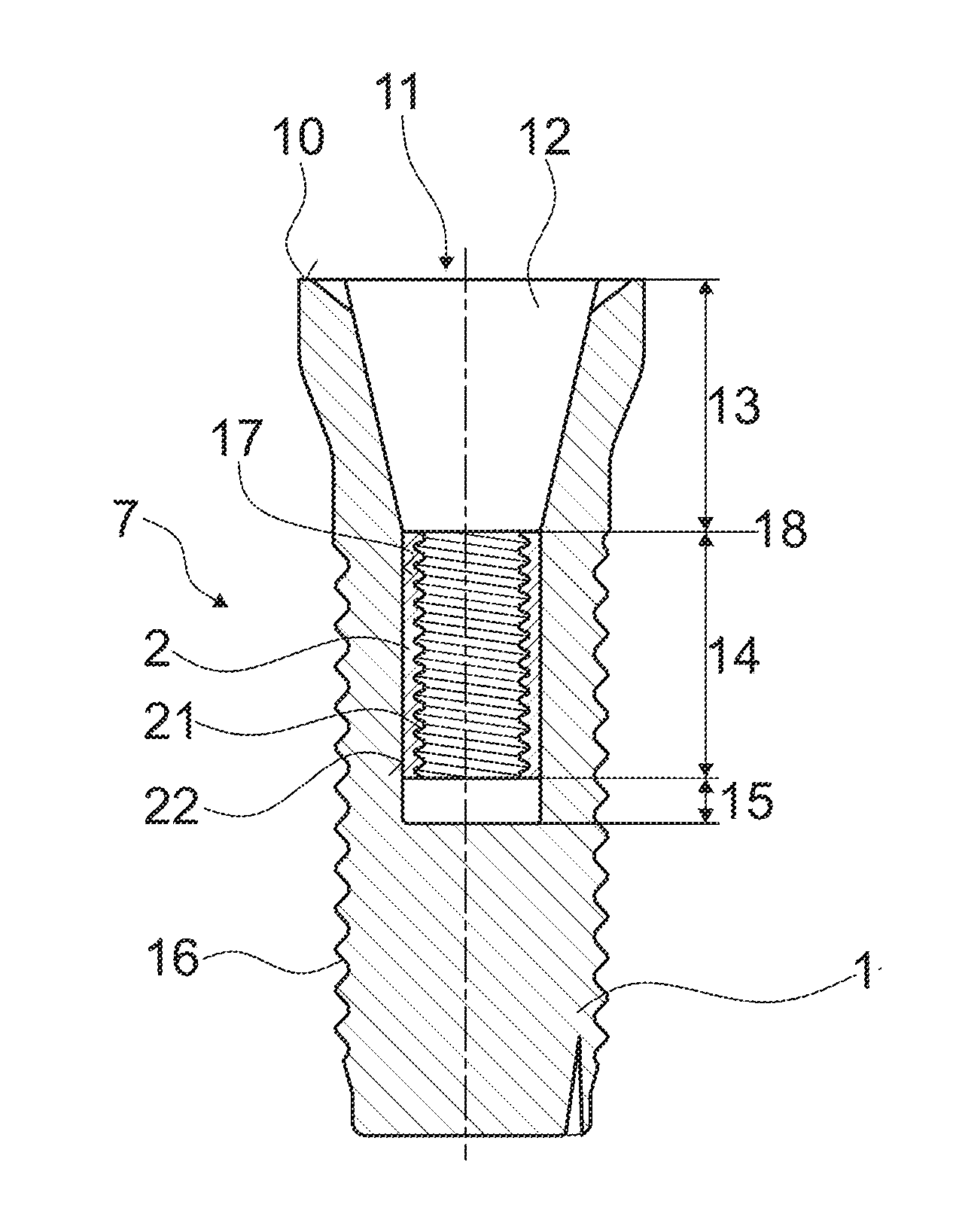 Dental implant system with ceramic implant