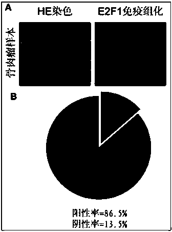 Application of E2F1 protein in preparation of medicine for diagnosing and treating osteosarcoma