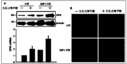 Application of E2F1 protein in preparation of medicine for diagnosing and treating osteosarcoma