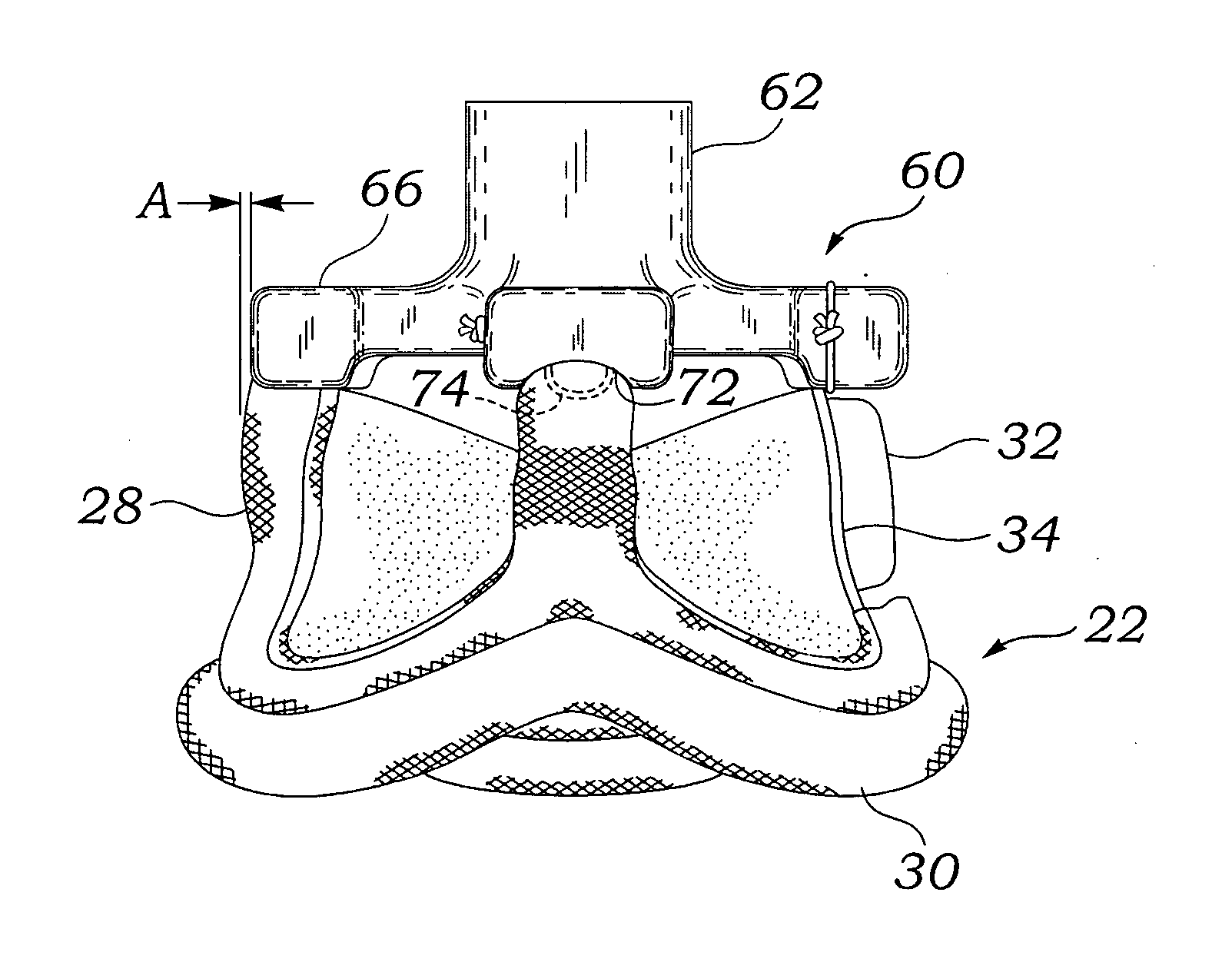 Holders for prosthetic aortic heart valves