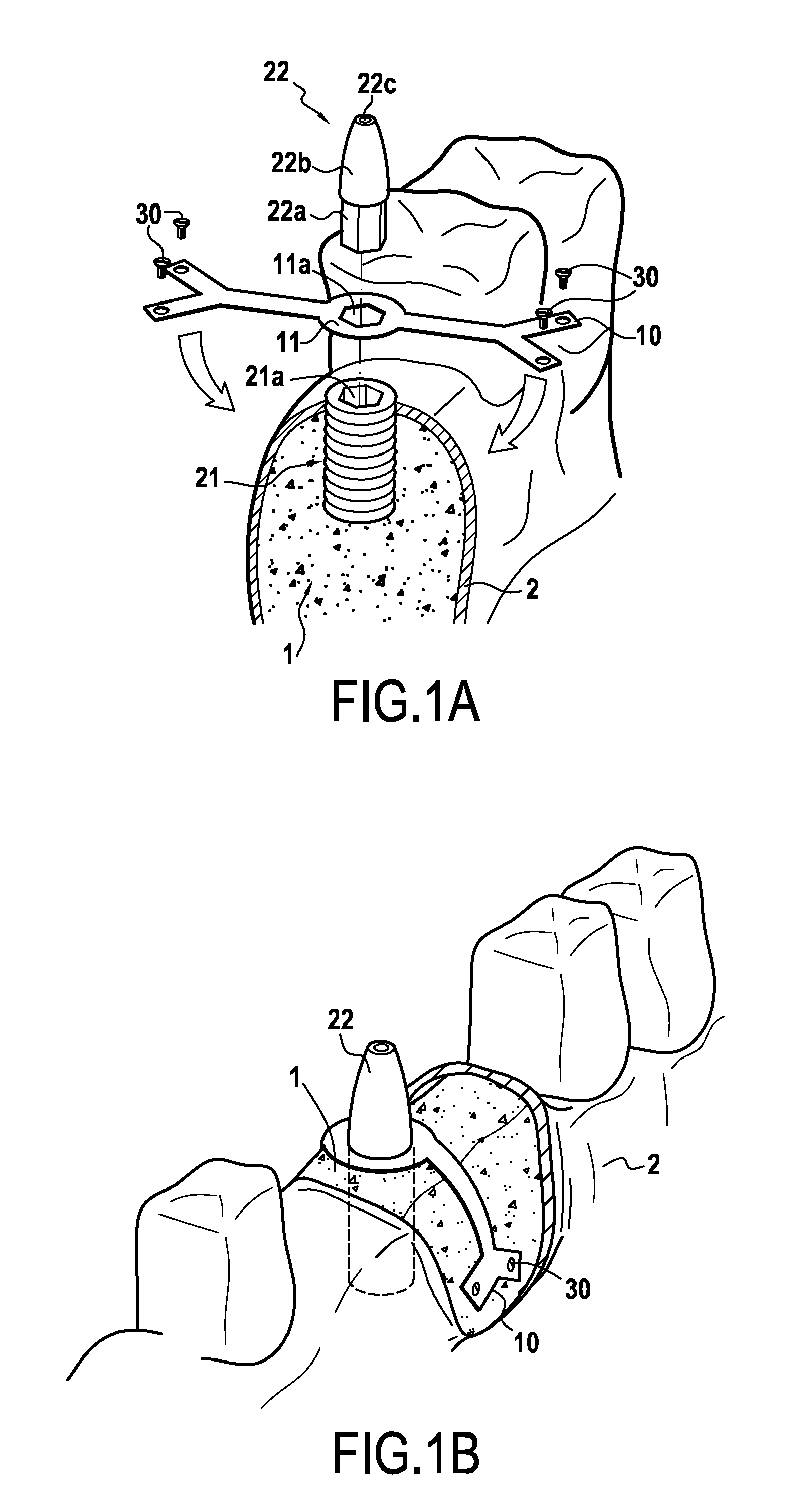 Additional stabilization device for endo-osseous dental implant