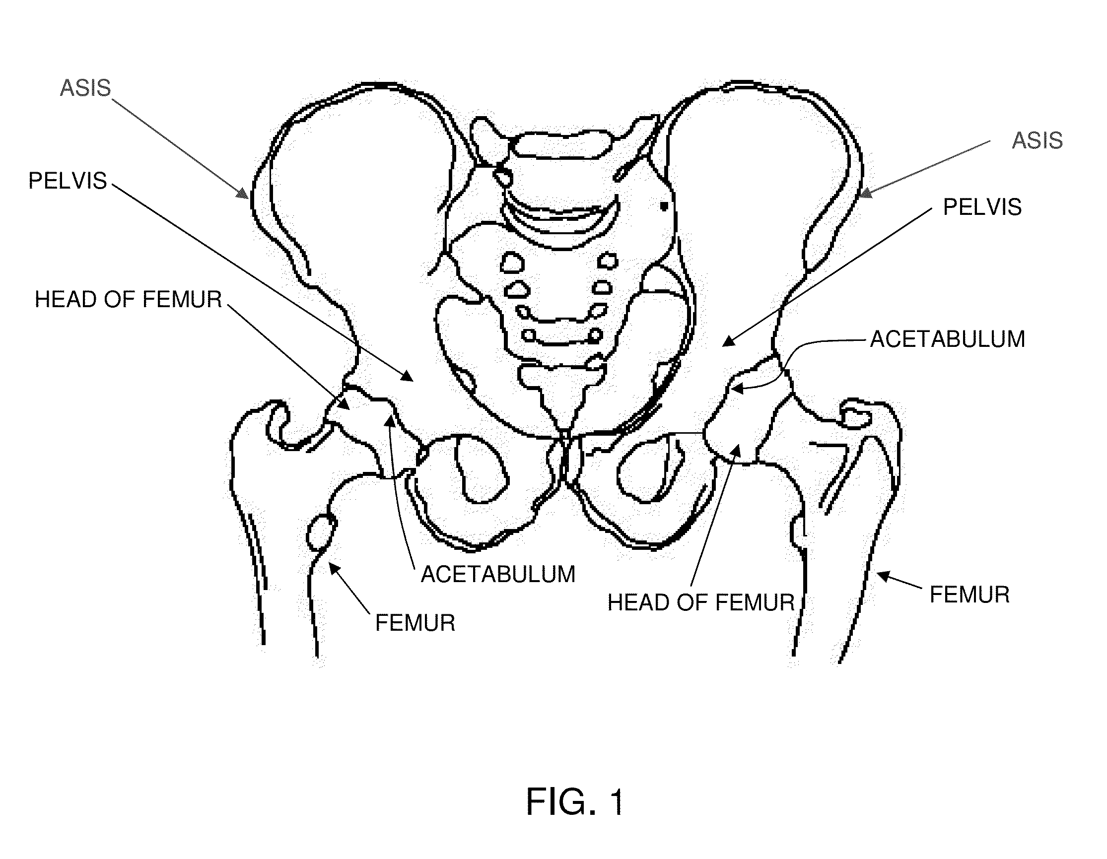 Computer-guided system for orienting a prosthetic acetabular cup in the acetabulum during total hip replacement surgery