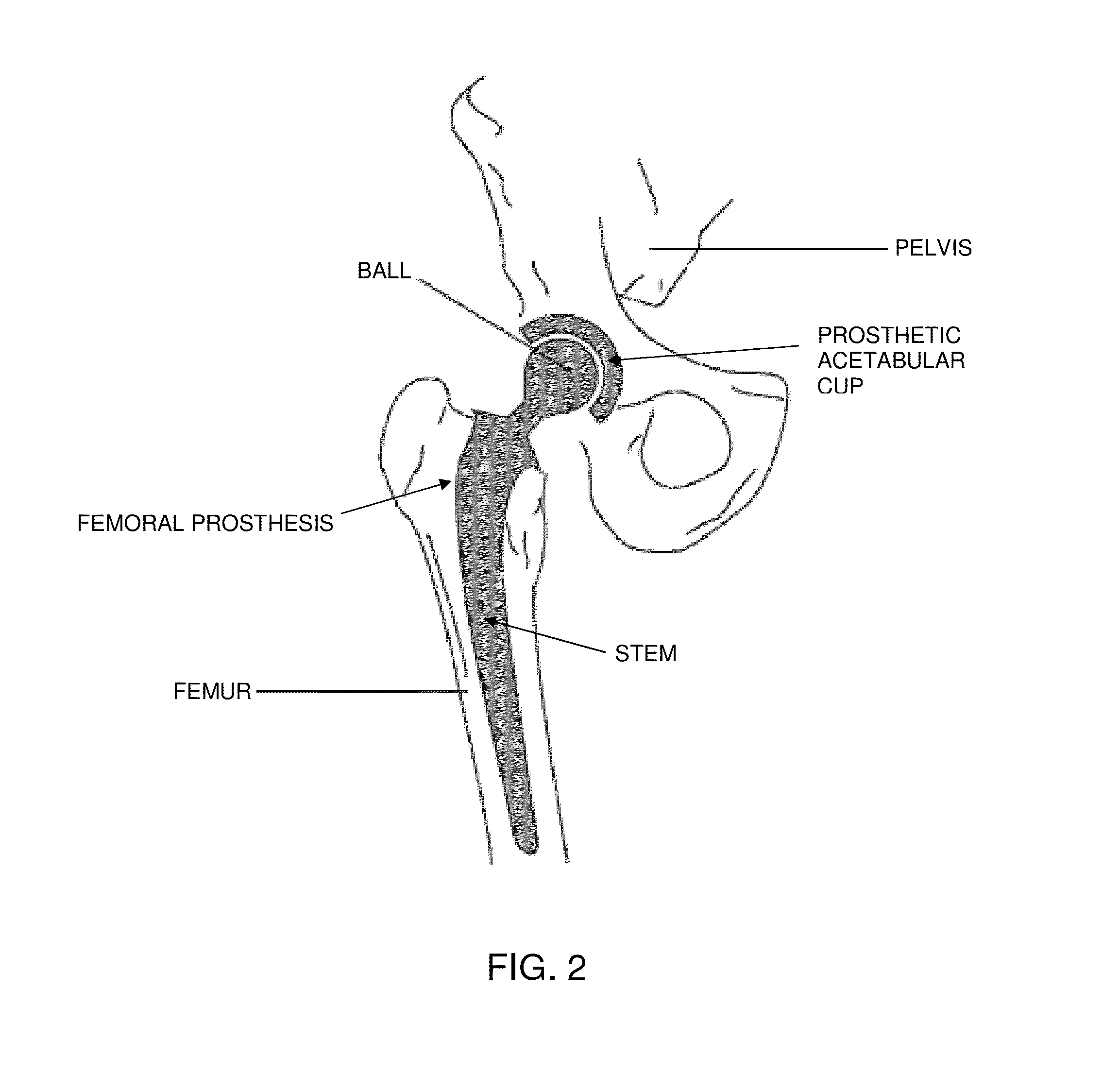 Computer-guided system for orienting a prosthetic acetabular cup in the acetabulum during total hip replacement surgery