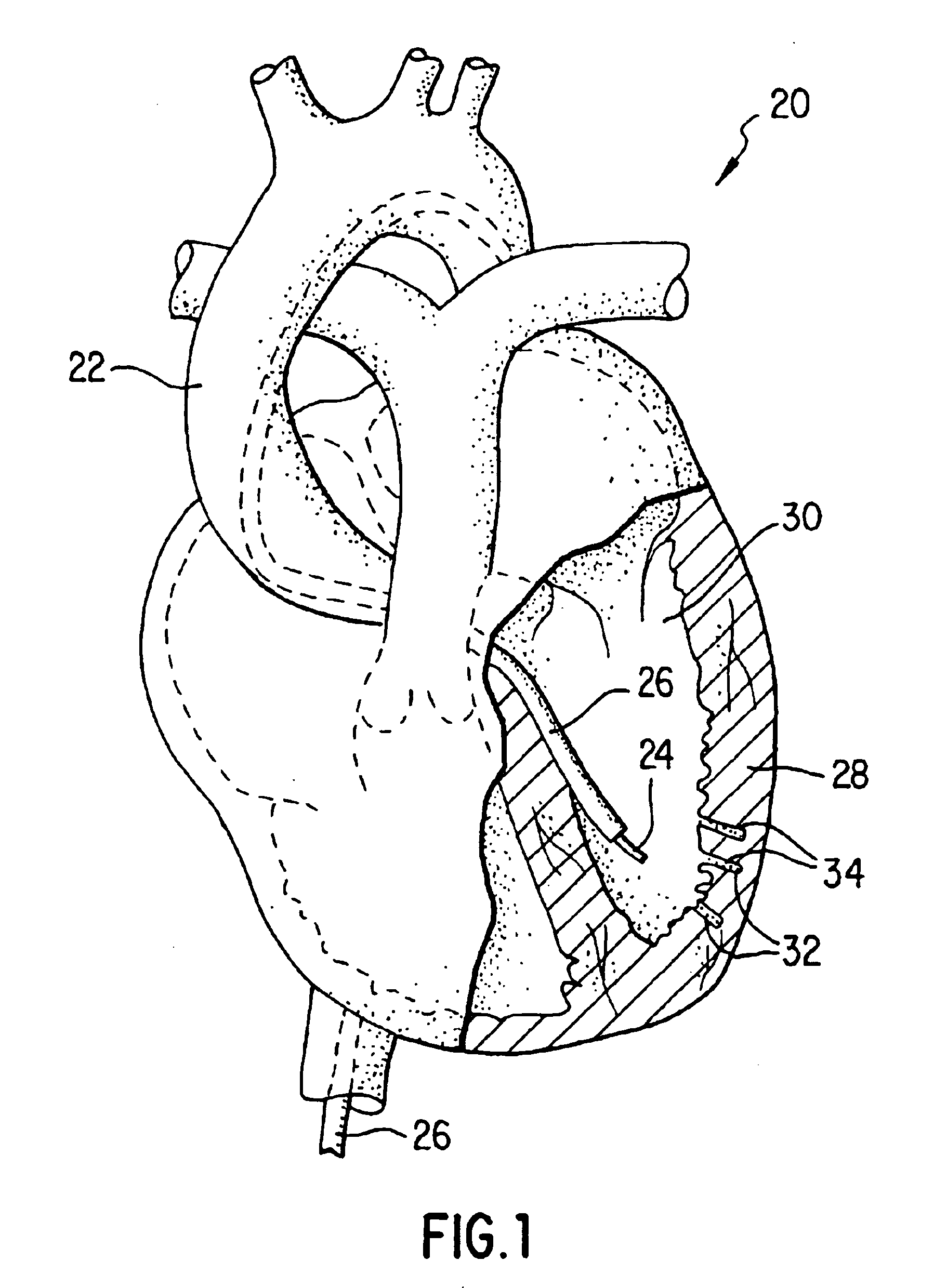 Methods for delivering a therapeutic implant to tissue