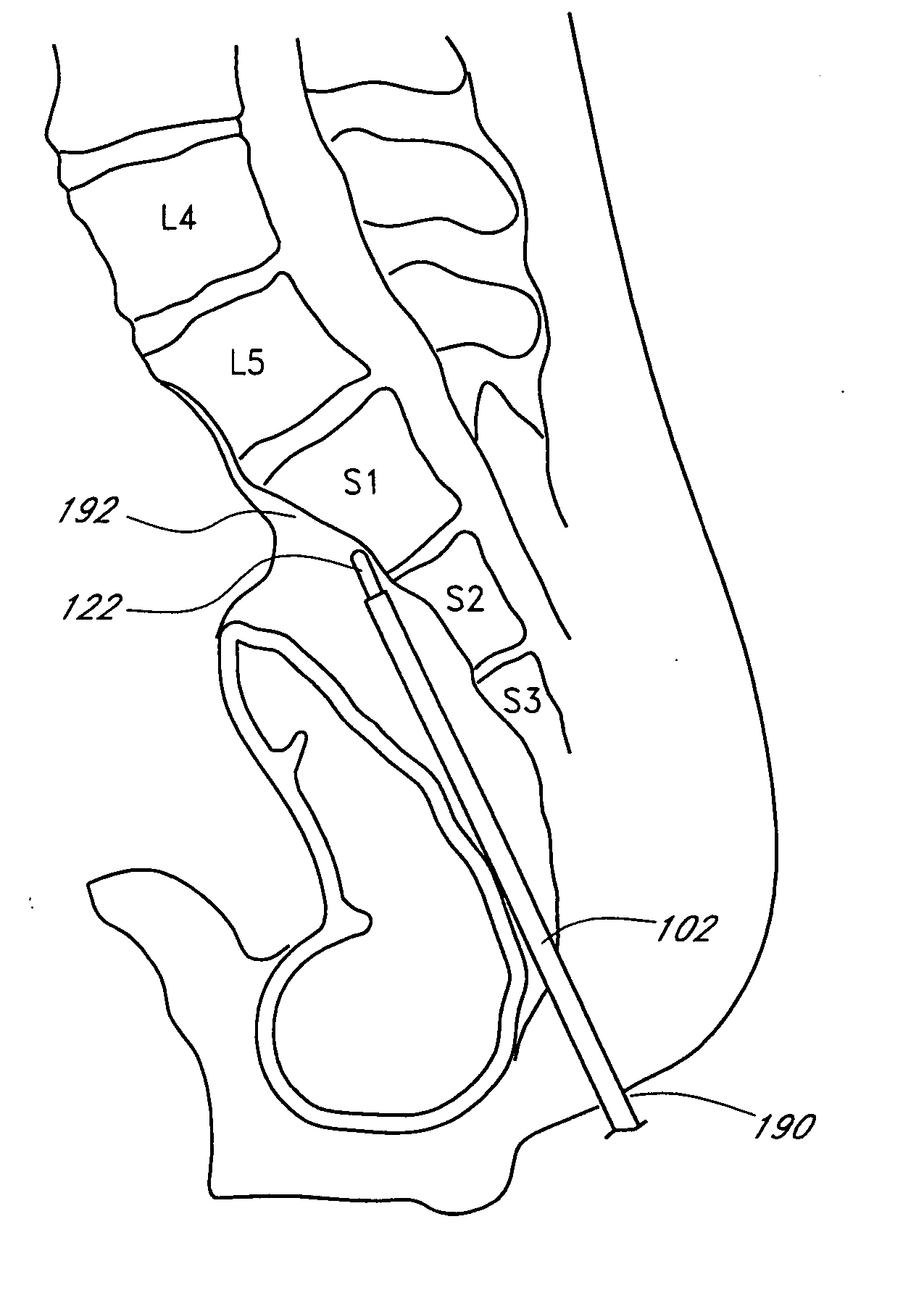 Exchange system for soft tissue access pathway