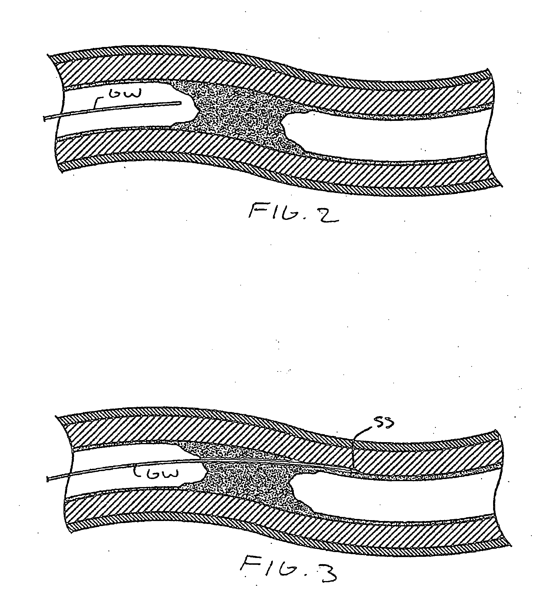 Methods and devices for rotating an active element and an energy emitter on a catheter