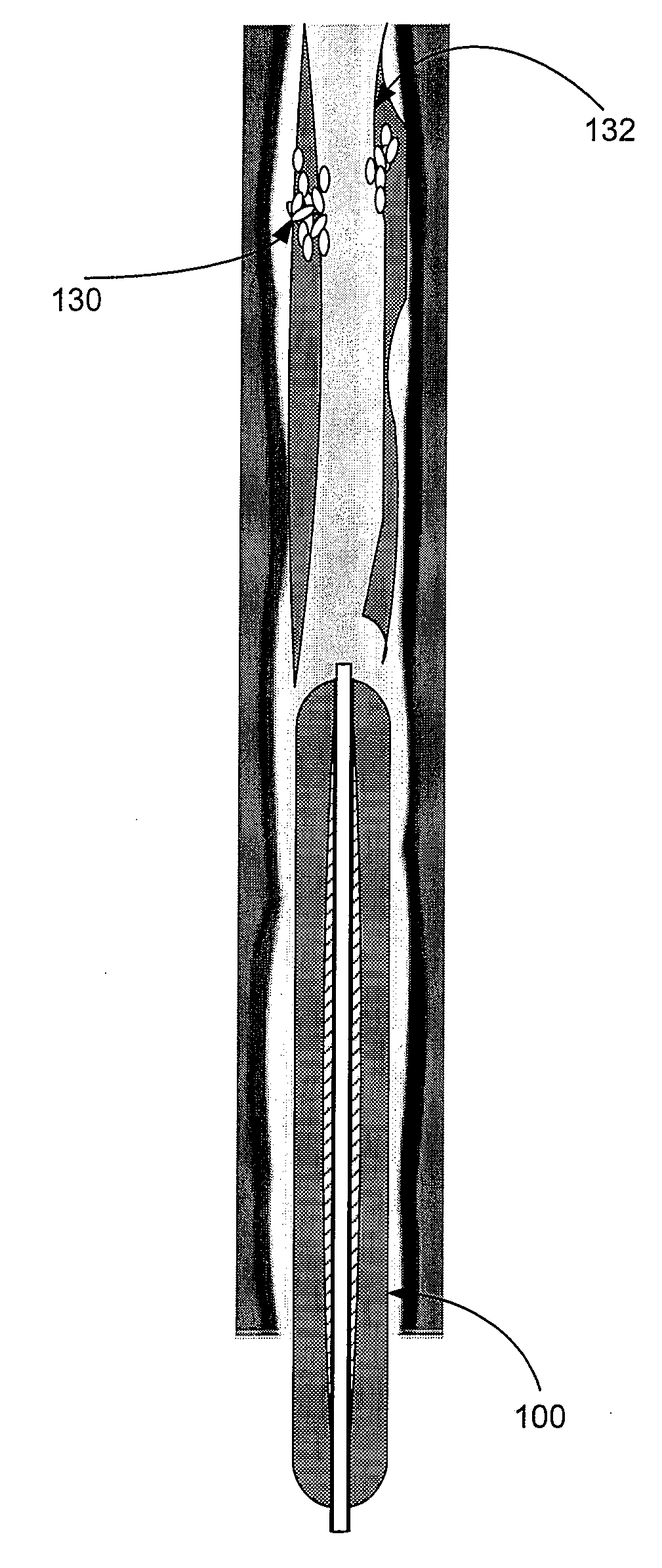 Methods and apparatus for treatment of venous insufficiency