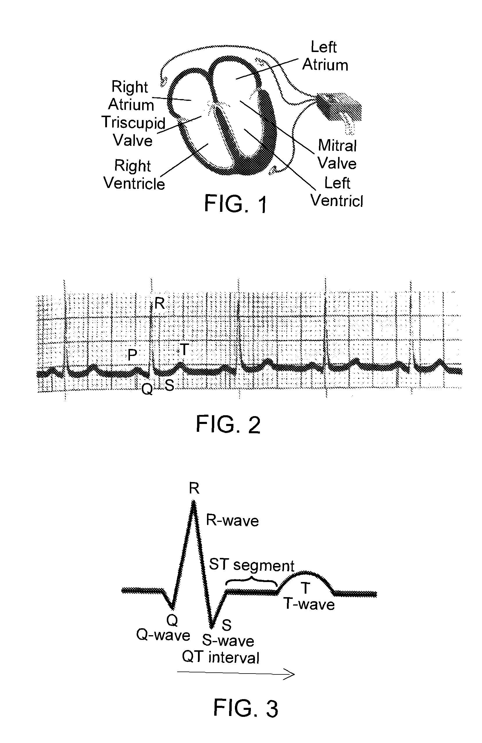 Biometric subject verification based on electrocardiographic signals