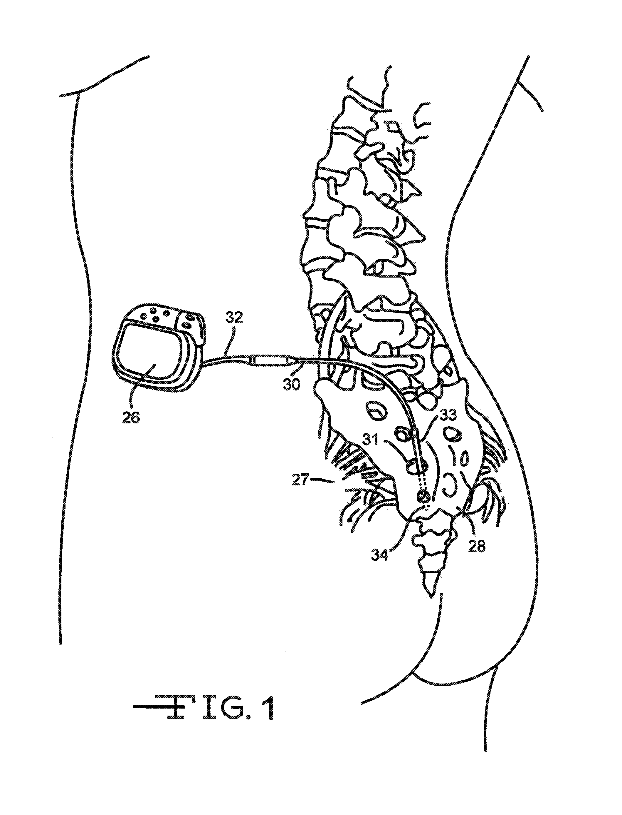 Minimally invasive methods for implanting a sacral stimulation lead