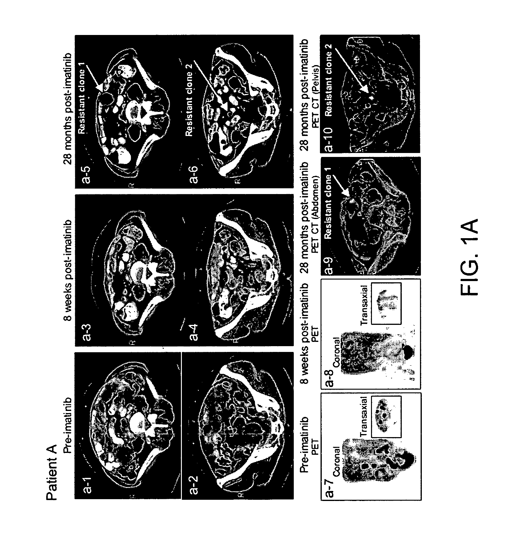 Mutations in KIT confer imatinib resistance in gastrointestinal stromal tumors