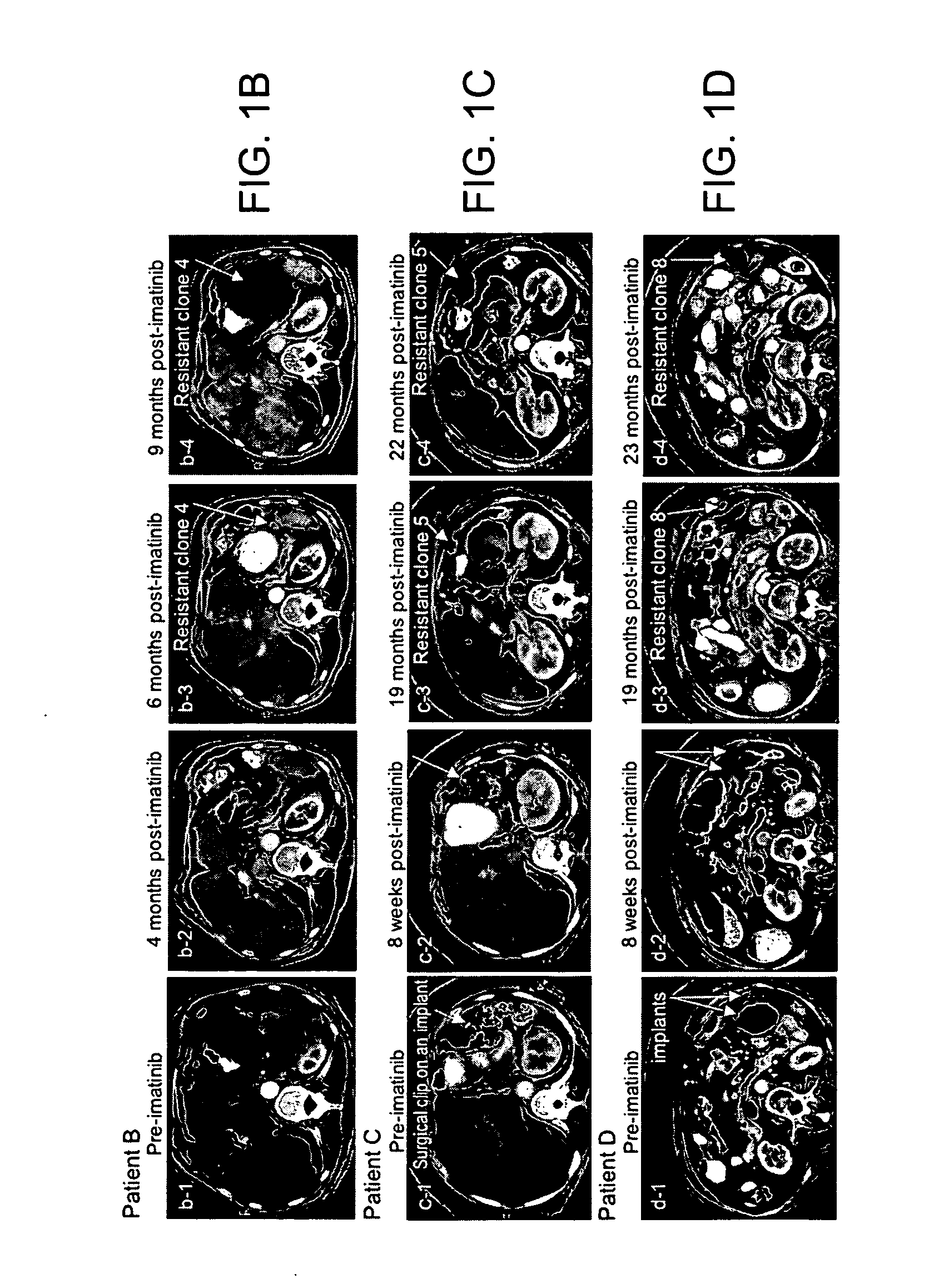 Mutations in KIT confer imatinib resistance in gastrointestinal stromal tumors