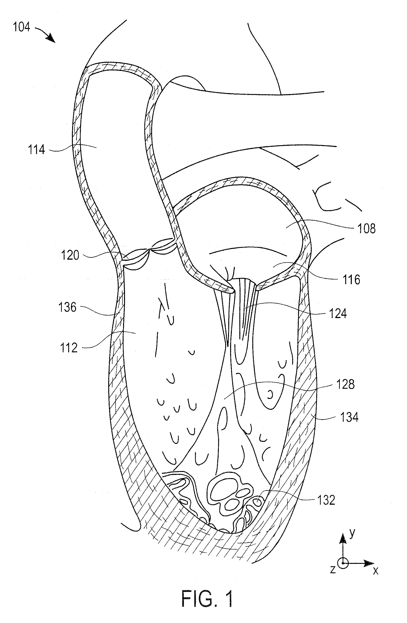 Method and apparatus for performing catheter-based annuloplasty using local plications