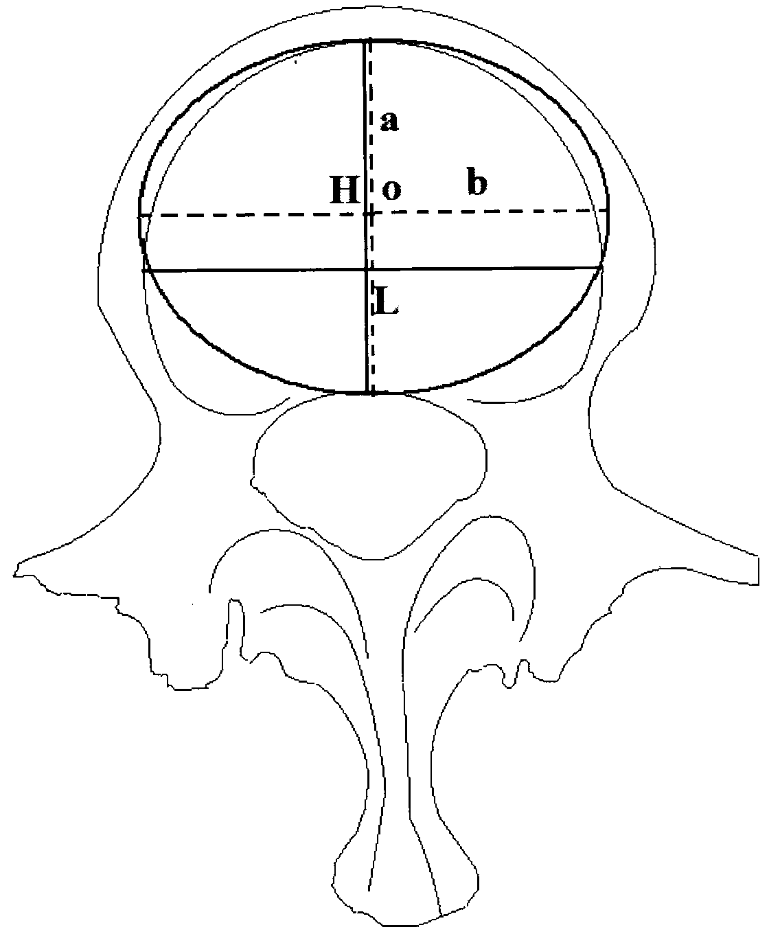 Bionic type hydraulic movable artificial vertebral body