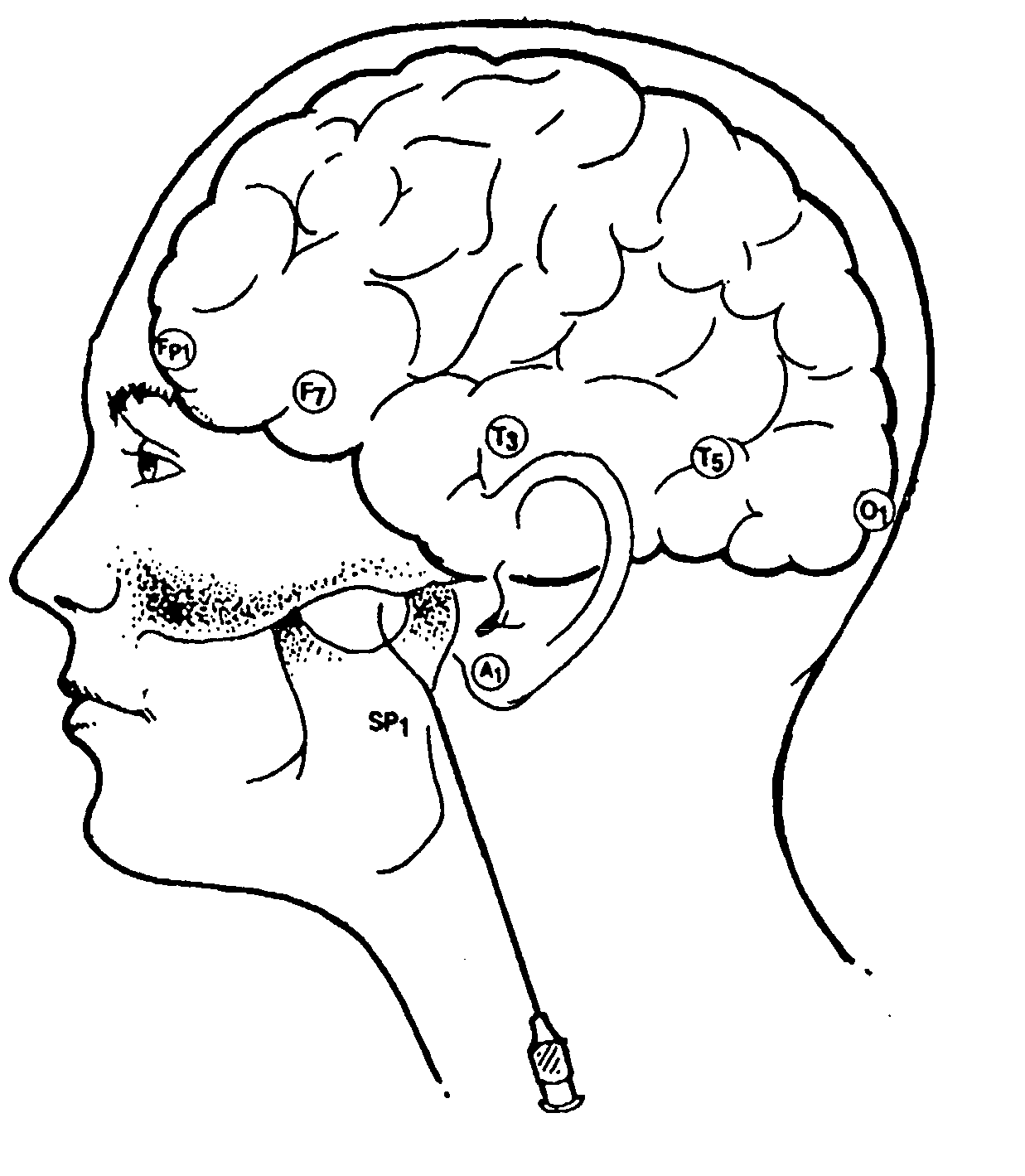 Noninvasive nonlinear systems and methods for predicting seizure