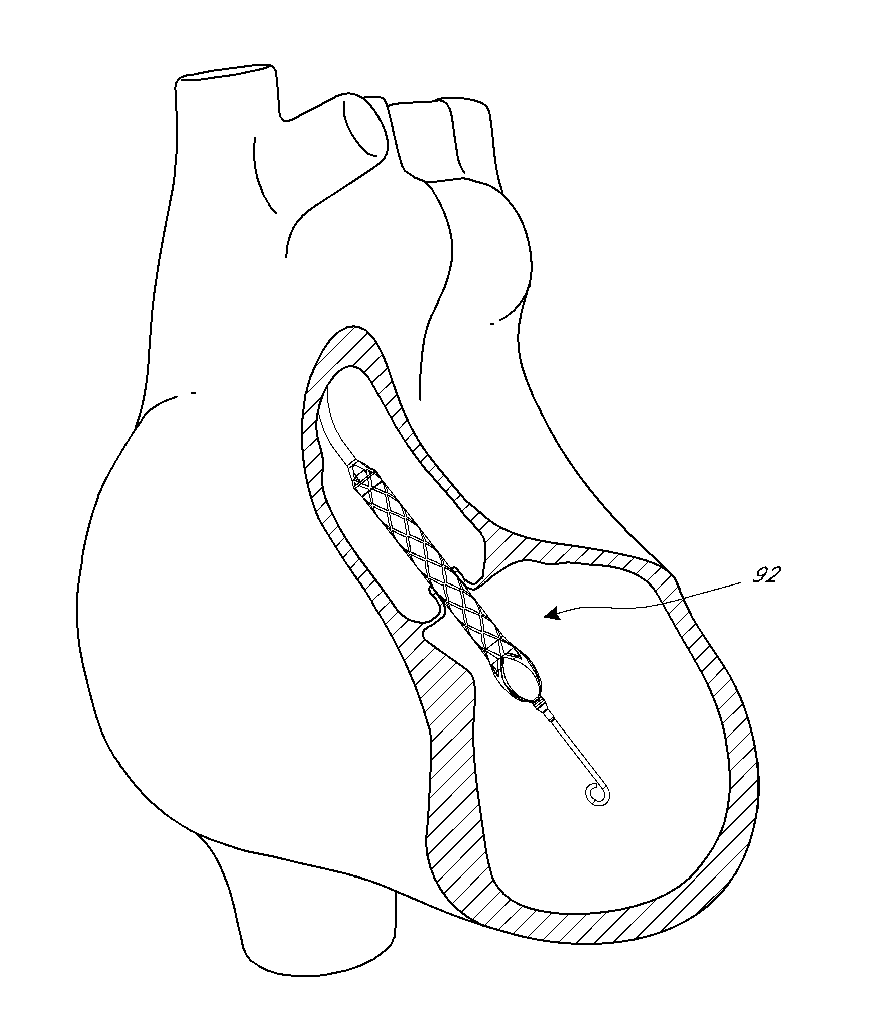 Distal bearing support