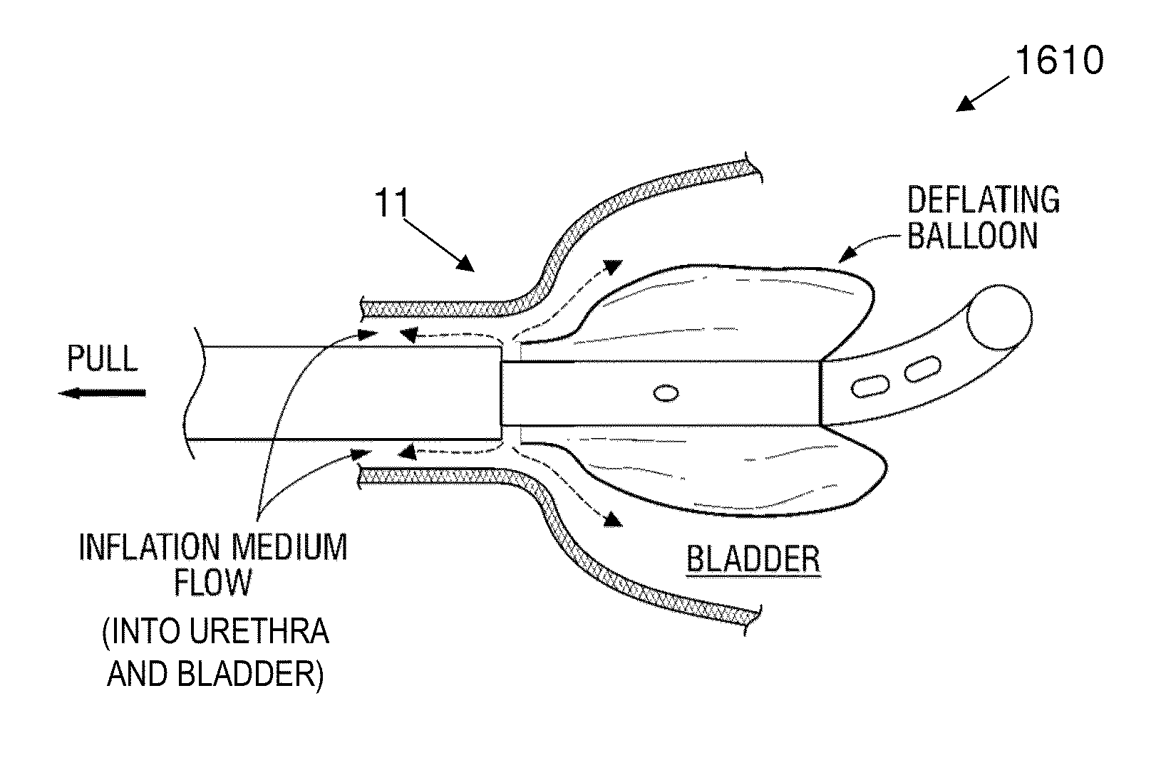 Stretch Valve Balloon Catheter and Methods for Producing and Using Same