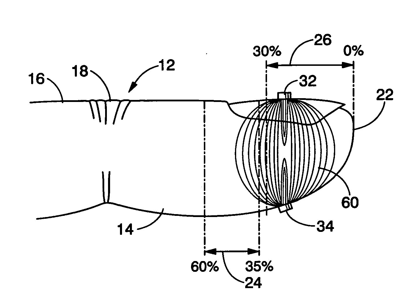 Pulse oximetry sensor and technique for using the same on a distal region of a patient's digit