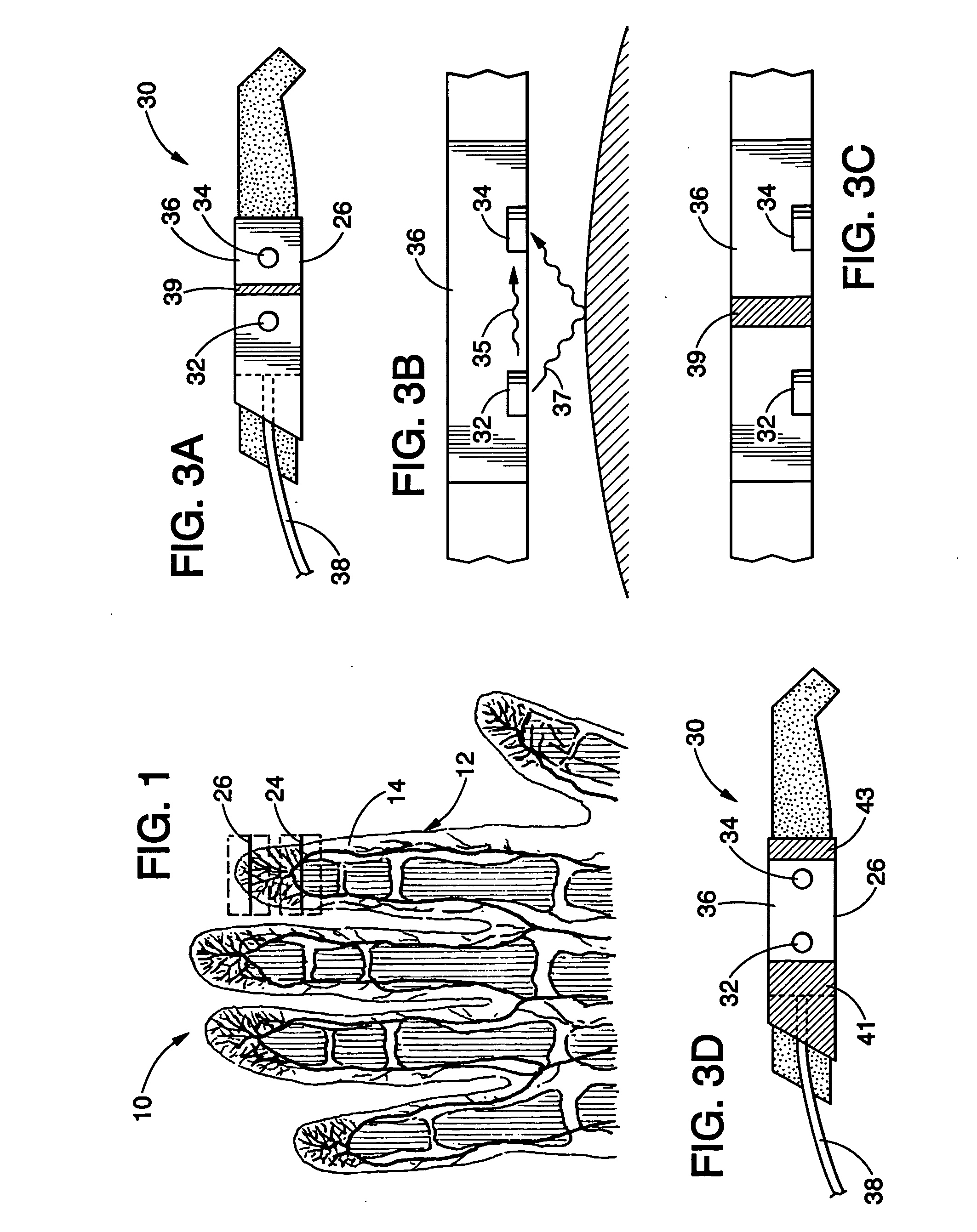 Pulse oximetry sensor and technique for using the same on a distal region of a patient's digit