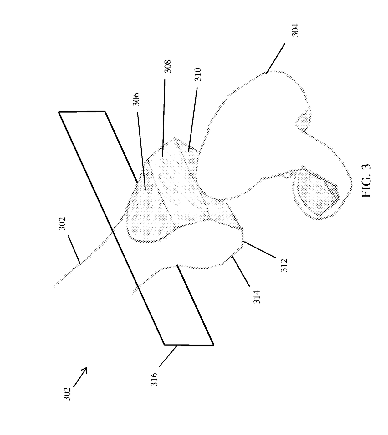 Active robotic pin placement in total knee arthroplasty