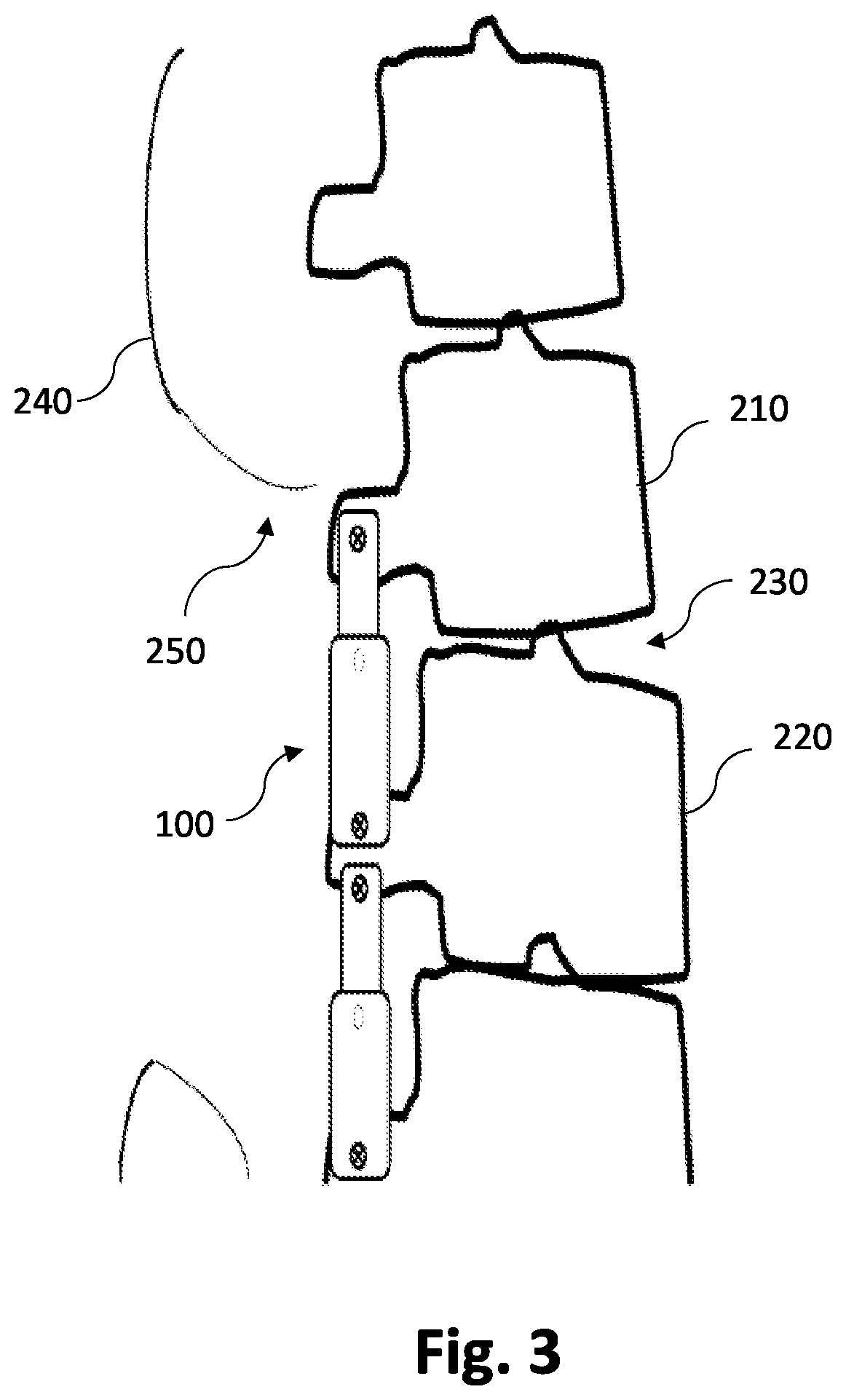 Non-invasively adjustable spinal stabilization device