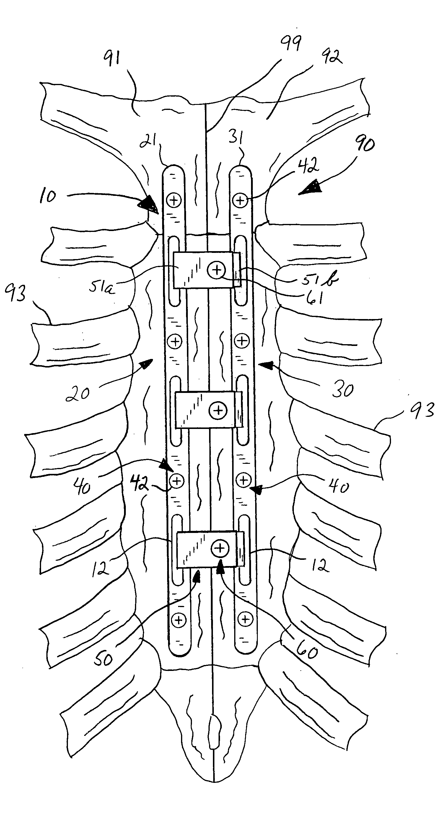 Sternal closure device