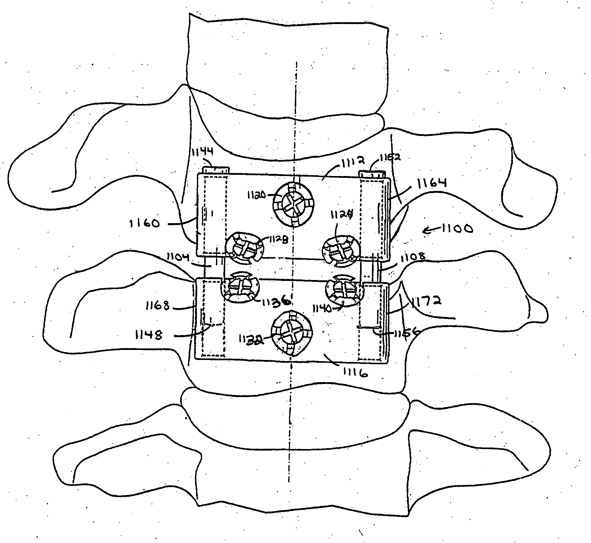 Methods and apparatuses for stabilizing the spine through an access device