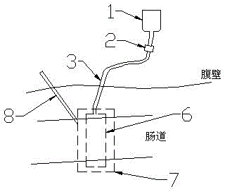 Enterocoelia growth factor dripping tube