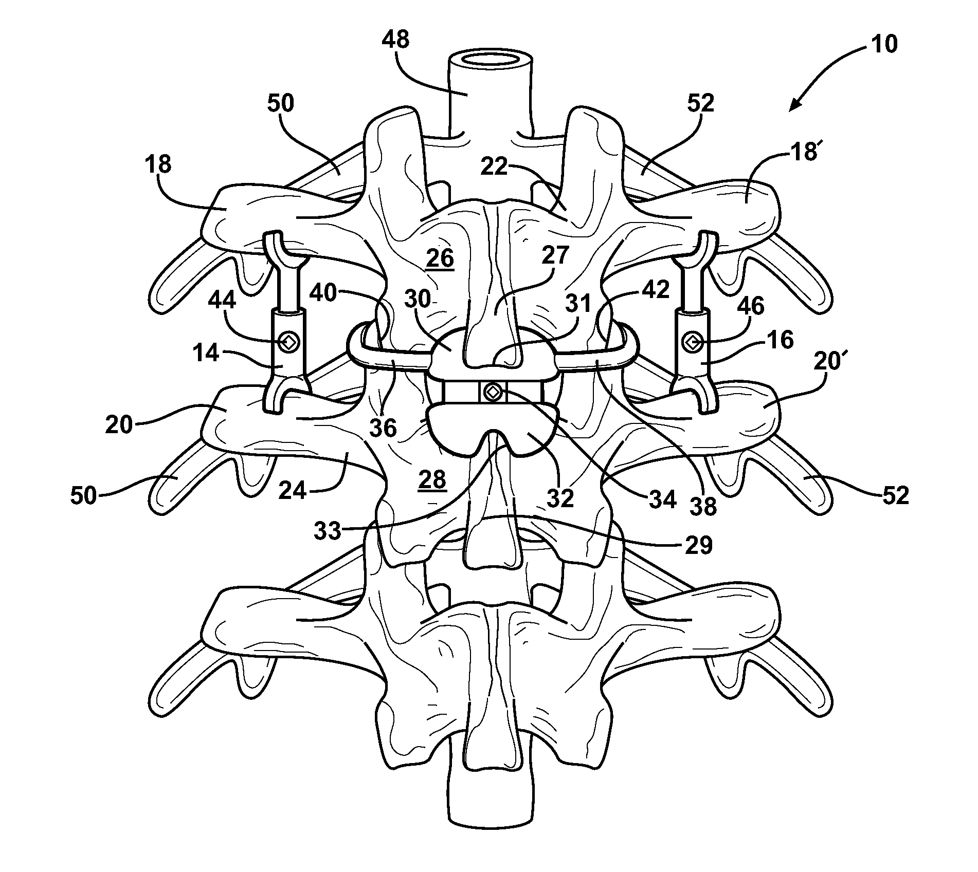 Support insert associated with spinal vertebrae