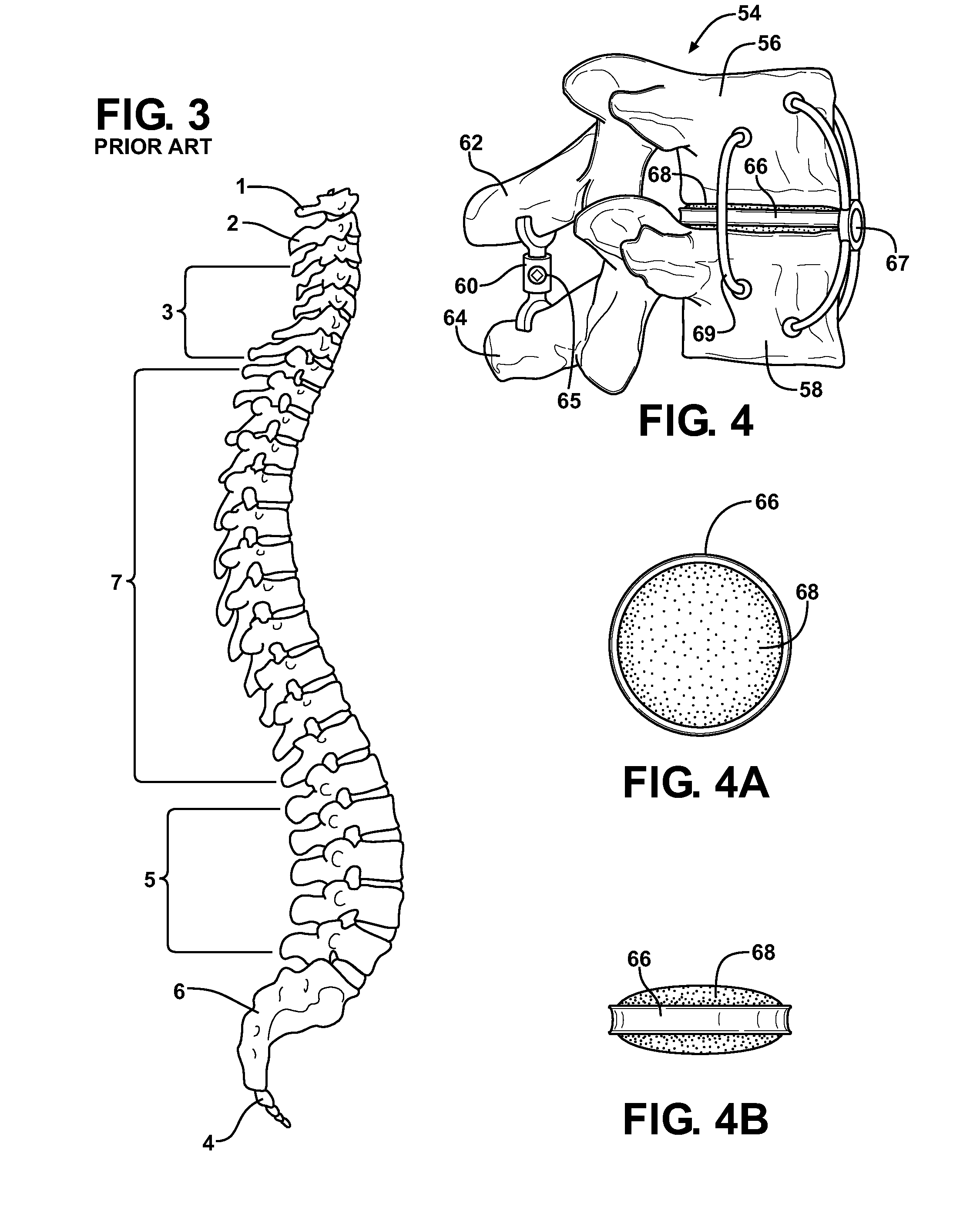 Support insert associated with spinal vertebrae