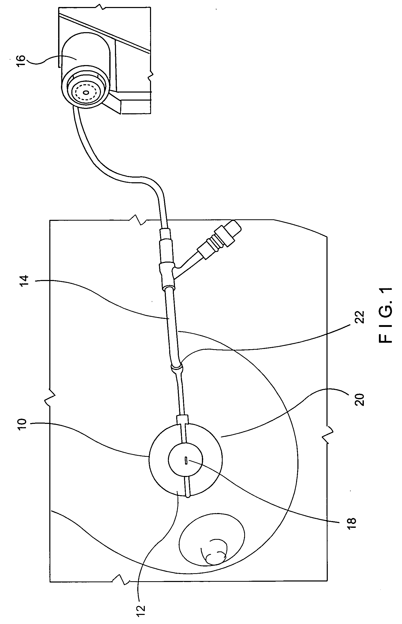 Temporary tissue spacer and pretreatment balloon