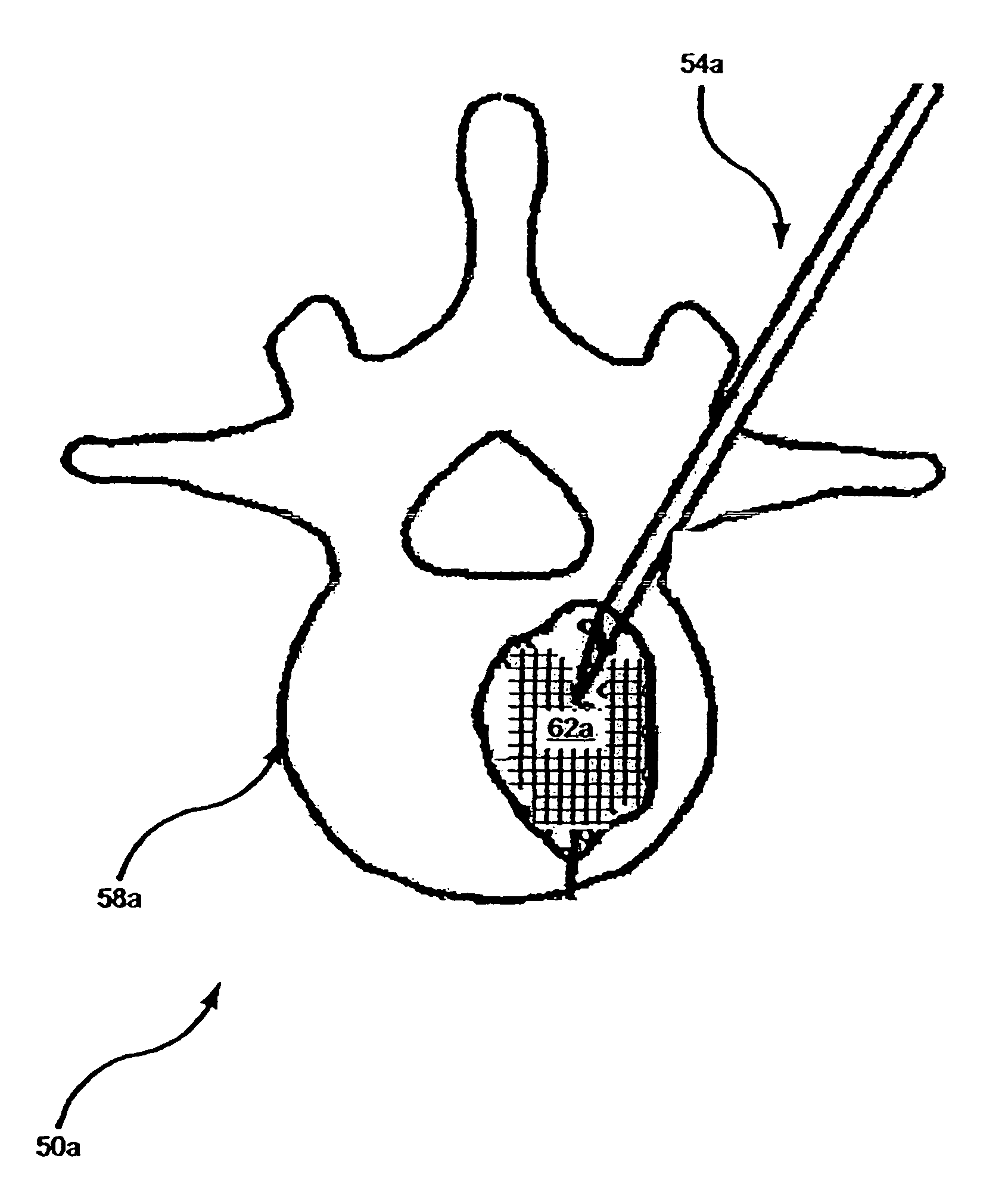 Methods and compositions for fostering and preserving bone growth