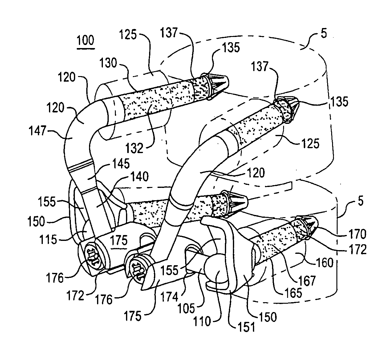 Crossbar spinal prosthesis having a modular design and related implantation methods