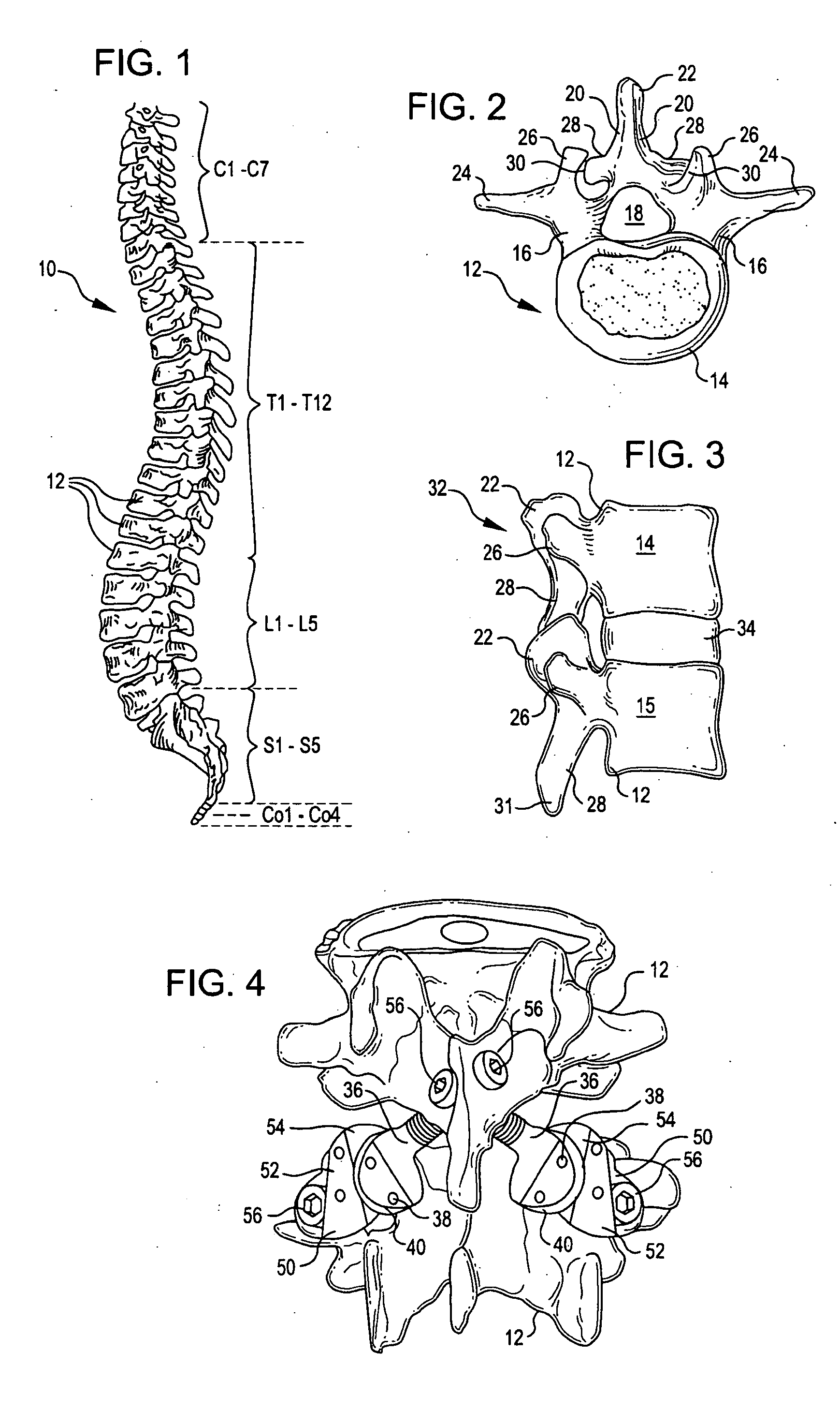 Crossbar spinal prosthesis having a modular design and related implantation methods