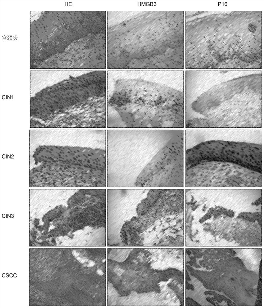 Molecular markers for screening and diagnosing early stage of cervical lesion and application of molecular markers