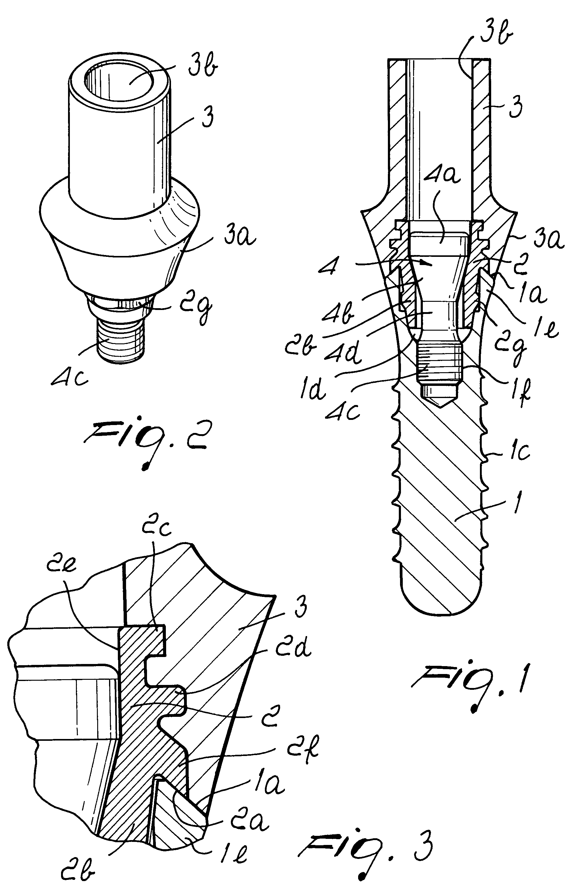 Dental implant system