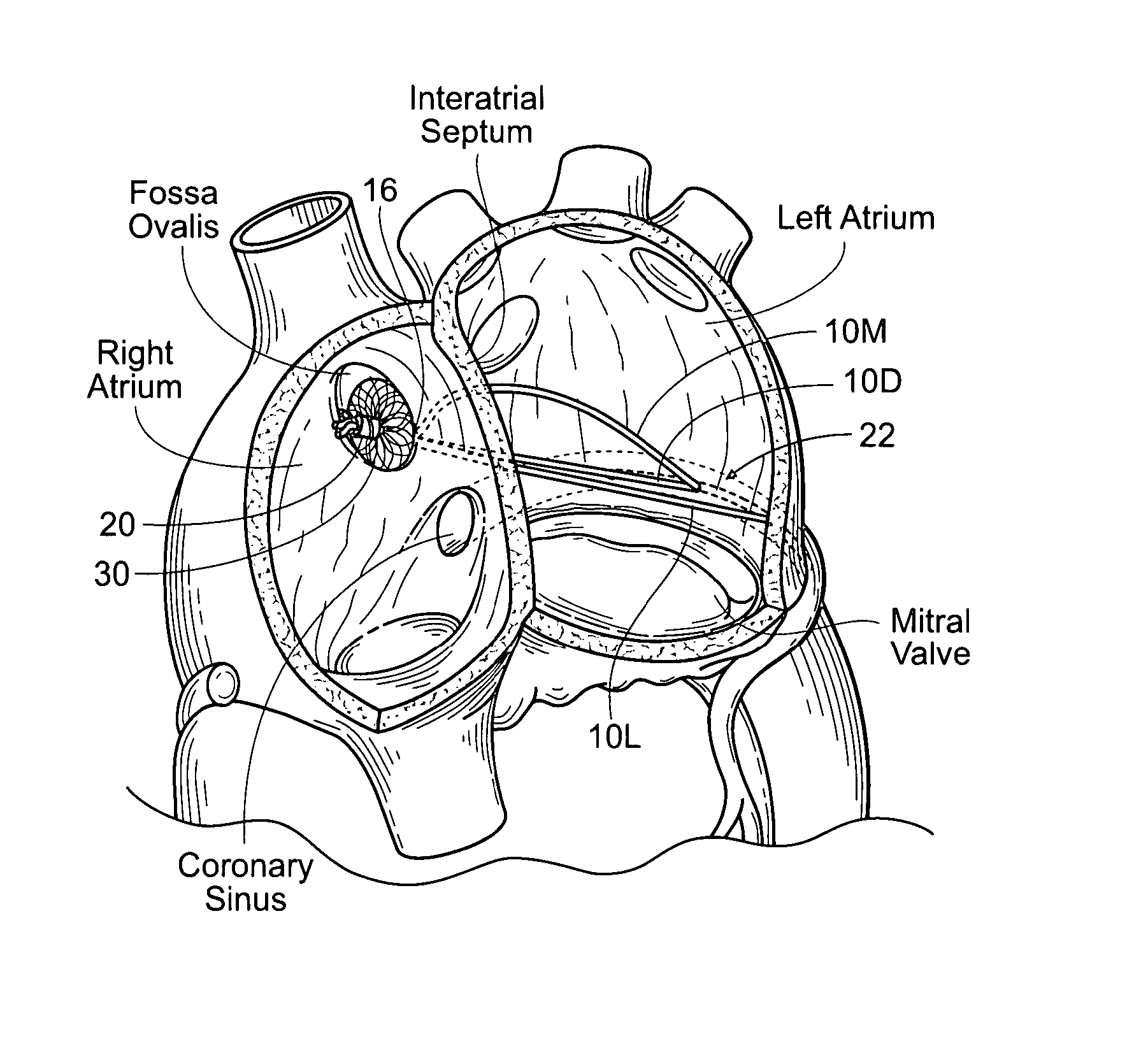 Devices, systems, and methods for reshaping a heart valve annulus, including the use of a bridge implant having an adjustable bridge stop