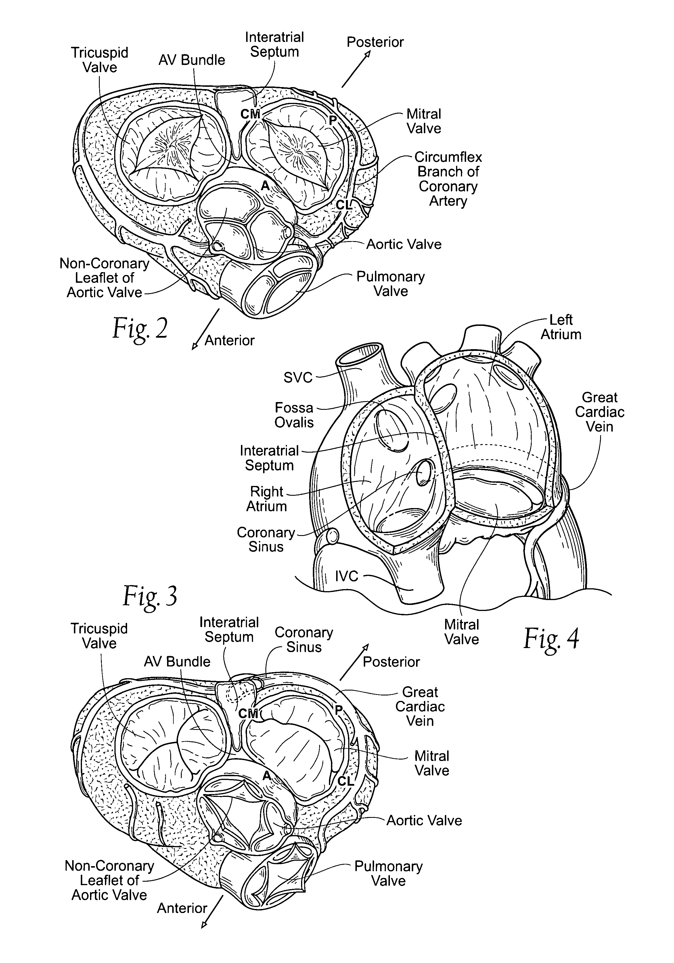 Devices, systems, and methods for reshaping a heart valve annulus, including the use of a bridge implant having an adjustable bridge stop