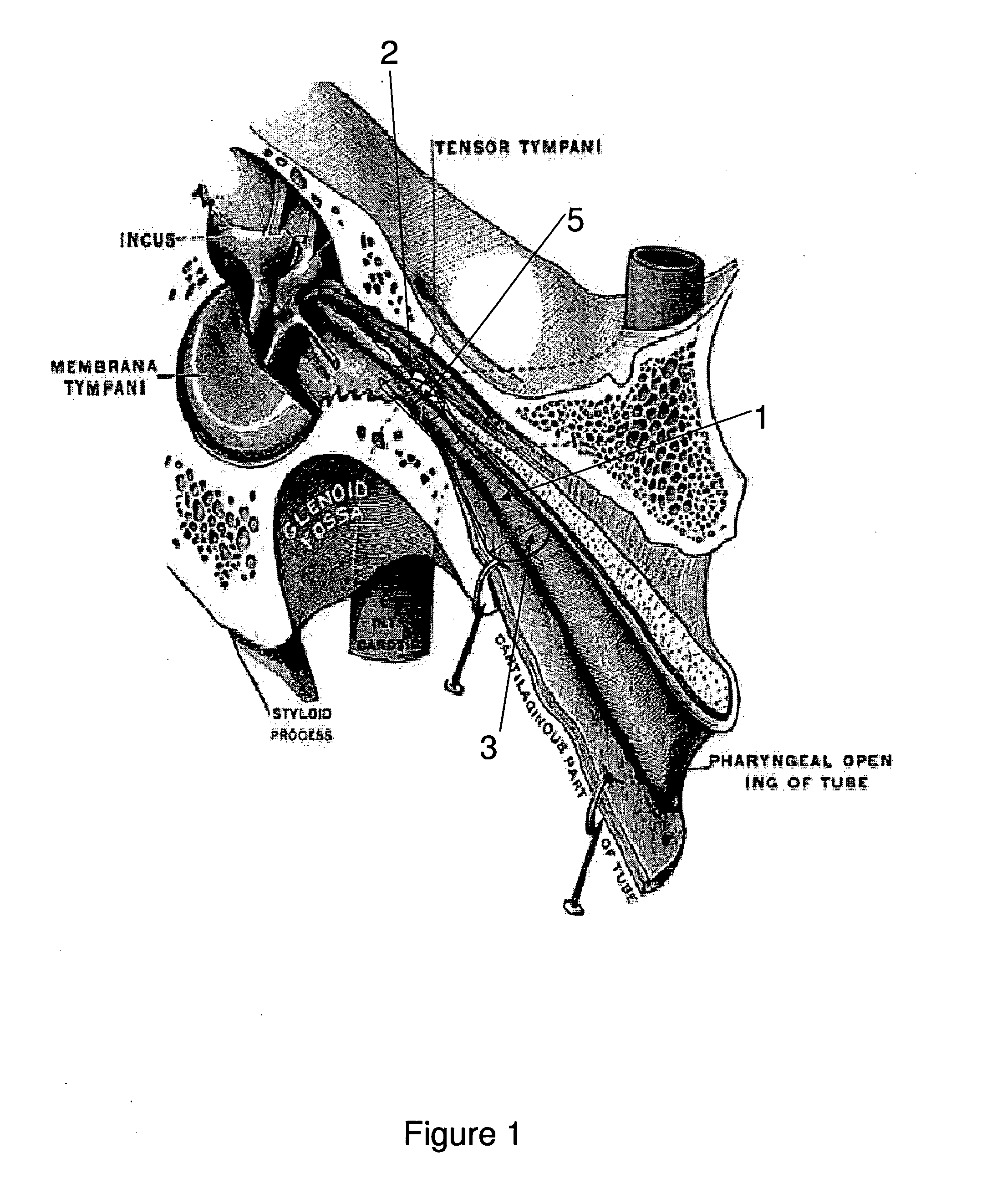 Eustachian tube device