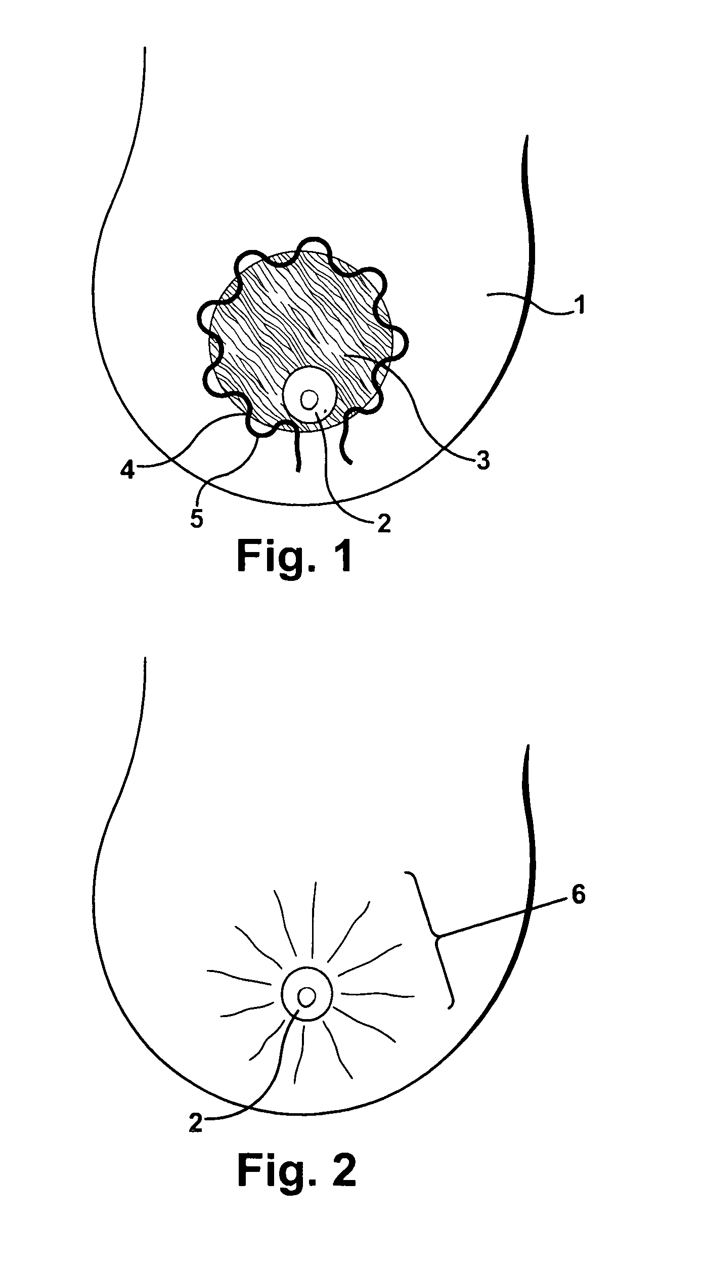 Implantable prosthesis for periareolar mastopexy